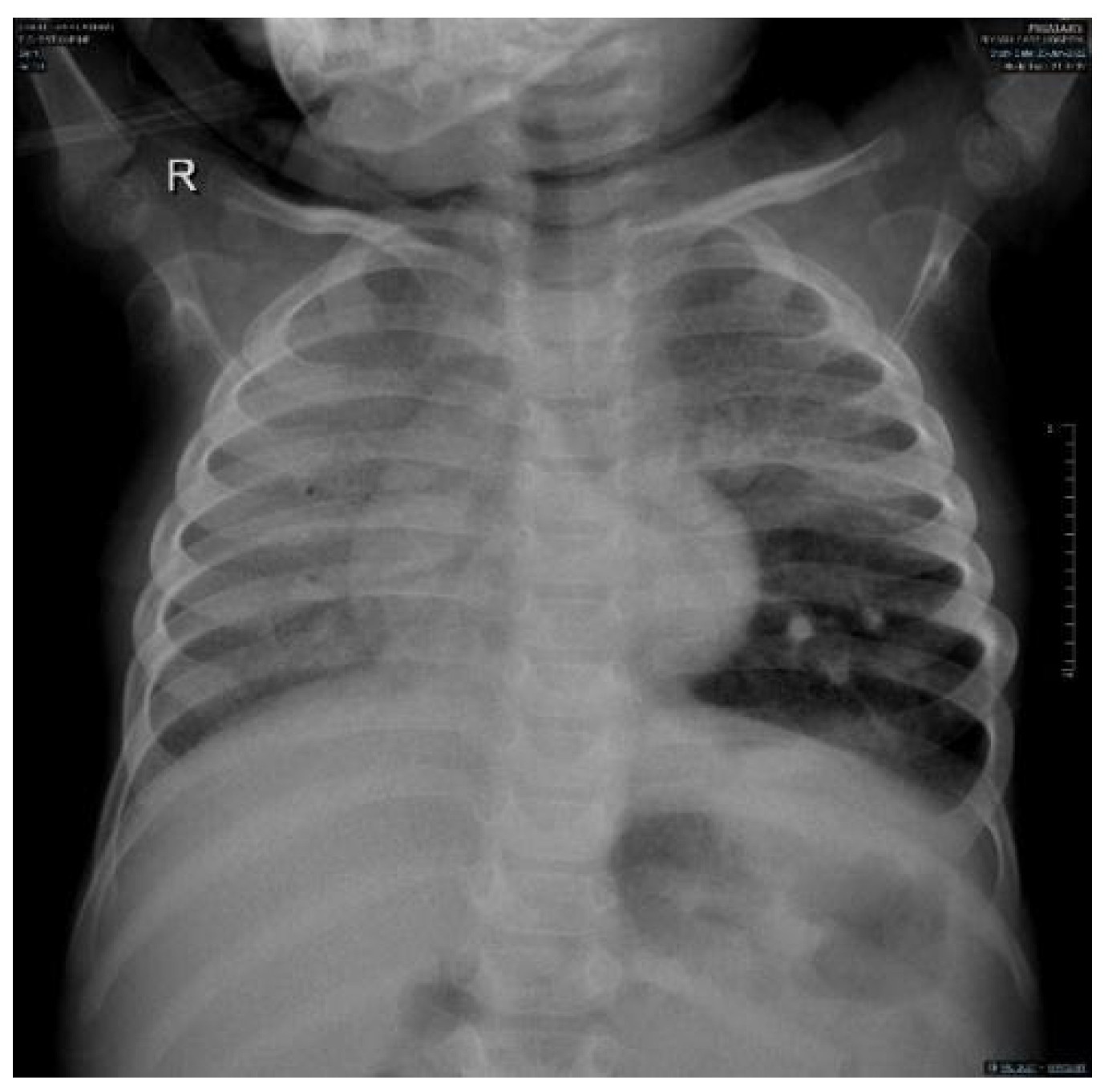 Niemann-Pick disease type B: HRCT assessment of pulmonary