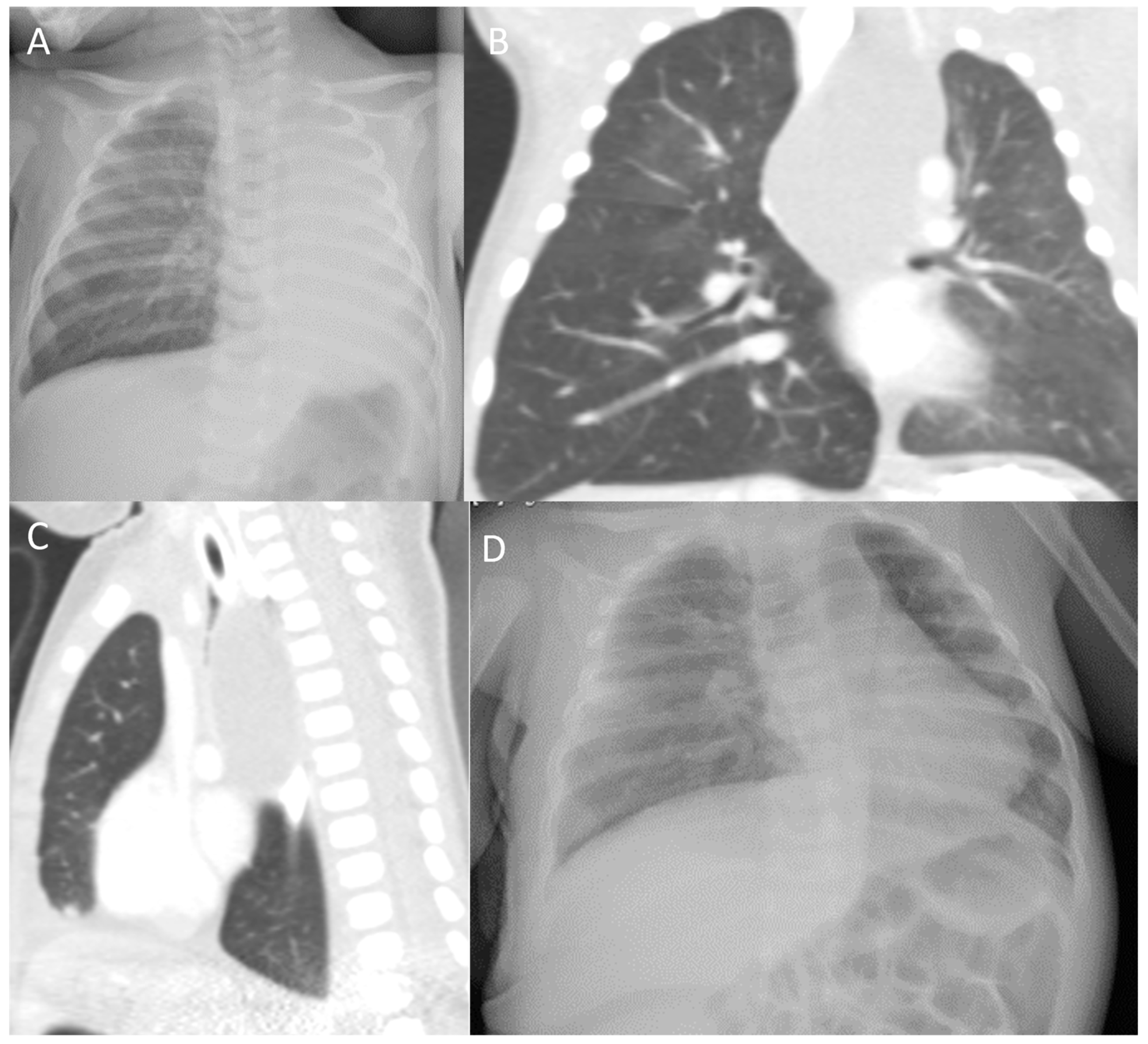 Children | Free Full-Text | Clinical Presentation and Surgical Management  of Five Pediatric Cases with Bronchogenic Cysts: Retrospective Case Series