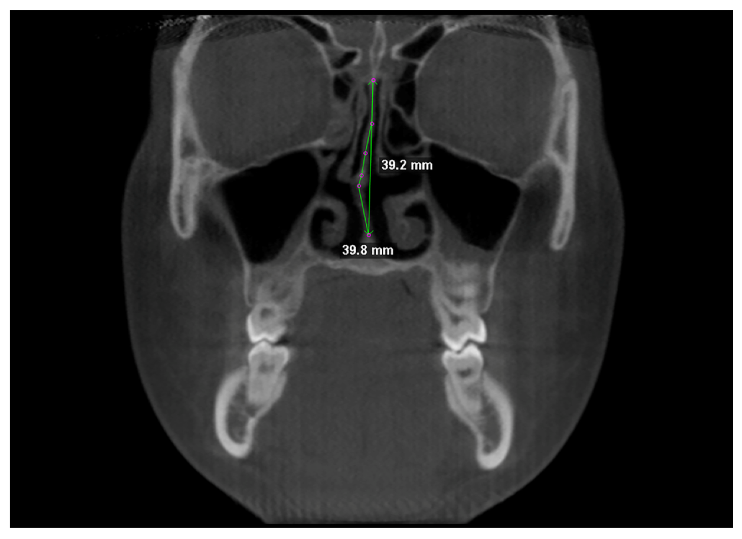 Nasal Septum Changes in Adolescents Treated with Tooth-Borne and Bone