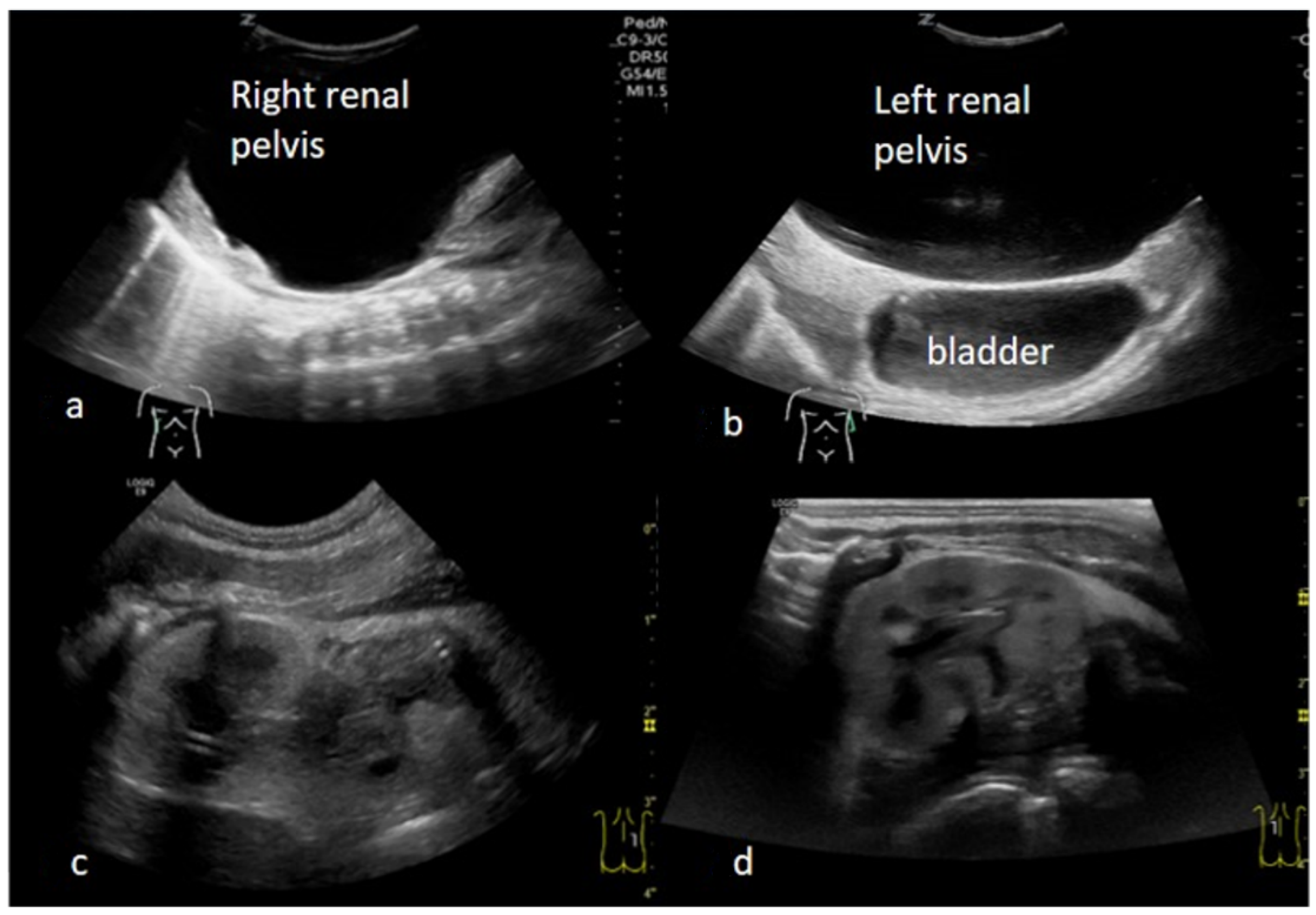 children-free-full-text-giant-bilateral-hydronephrosis-in-a-newborn