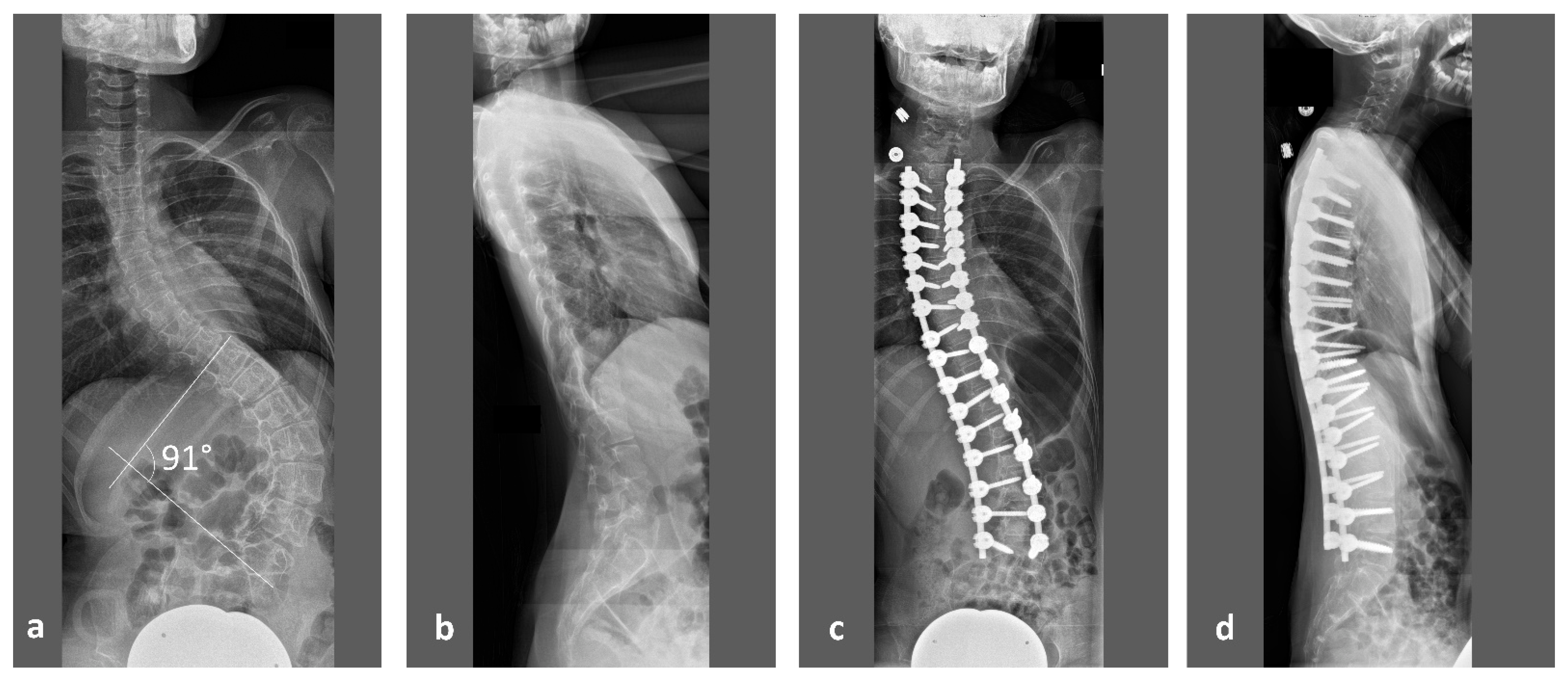 X ray dorso lumbar spine A/P and lateral views showing Kypho