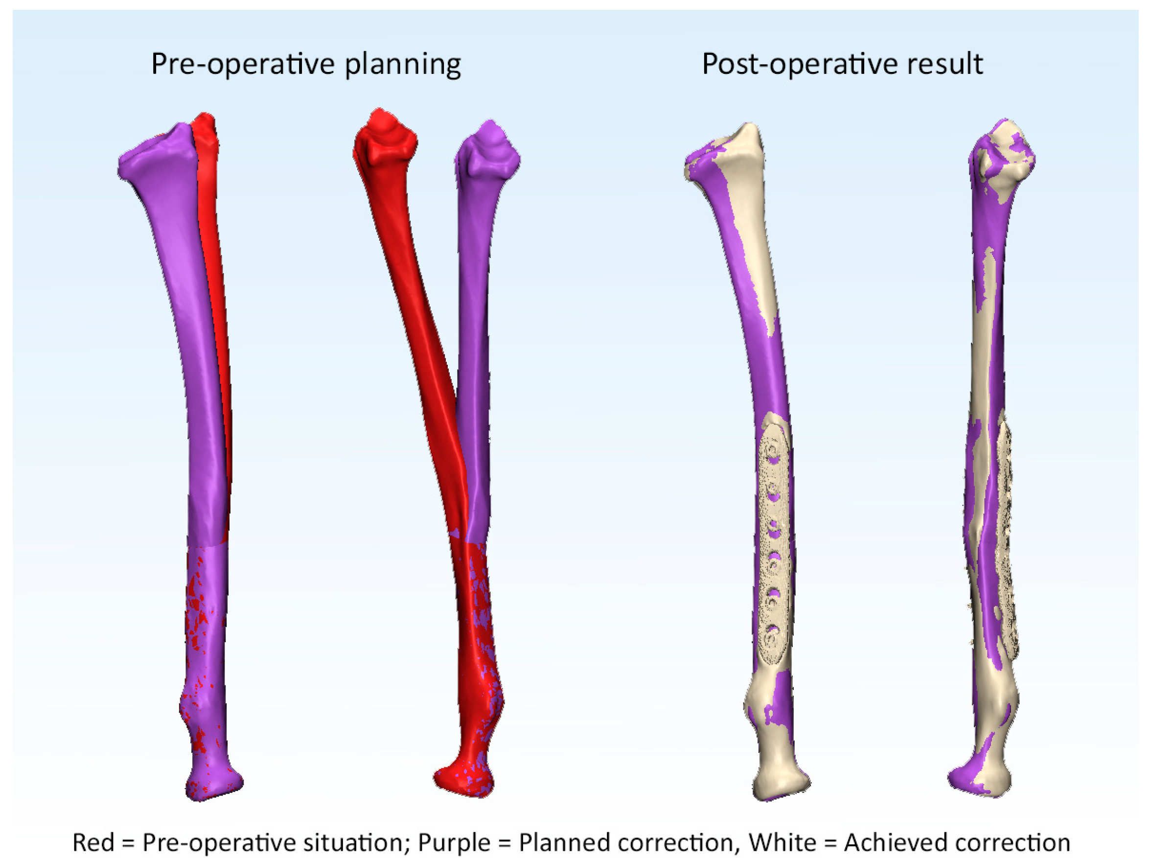 Revista Brasileira de Ortopedia - Treatment of Distal Radio Vicious  Consolidation: Corrective Osteotomy Through 3D Printing  Prototyping<sup>*</sup>