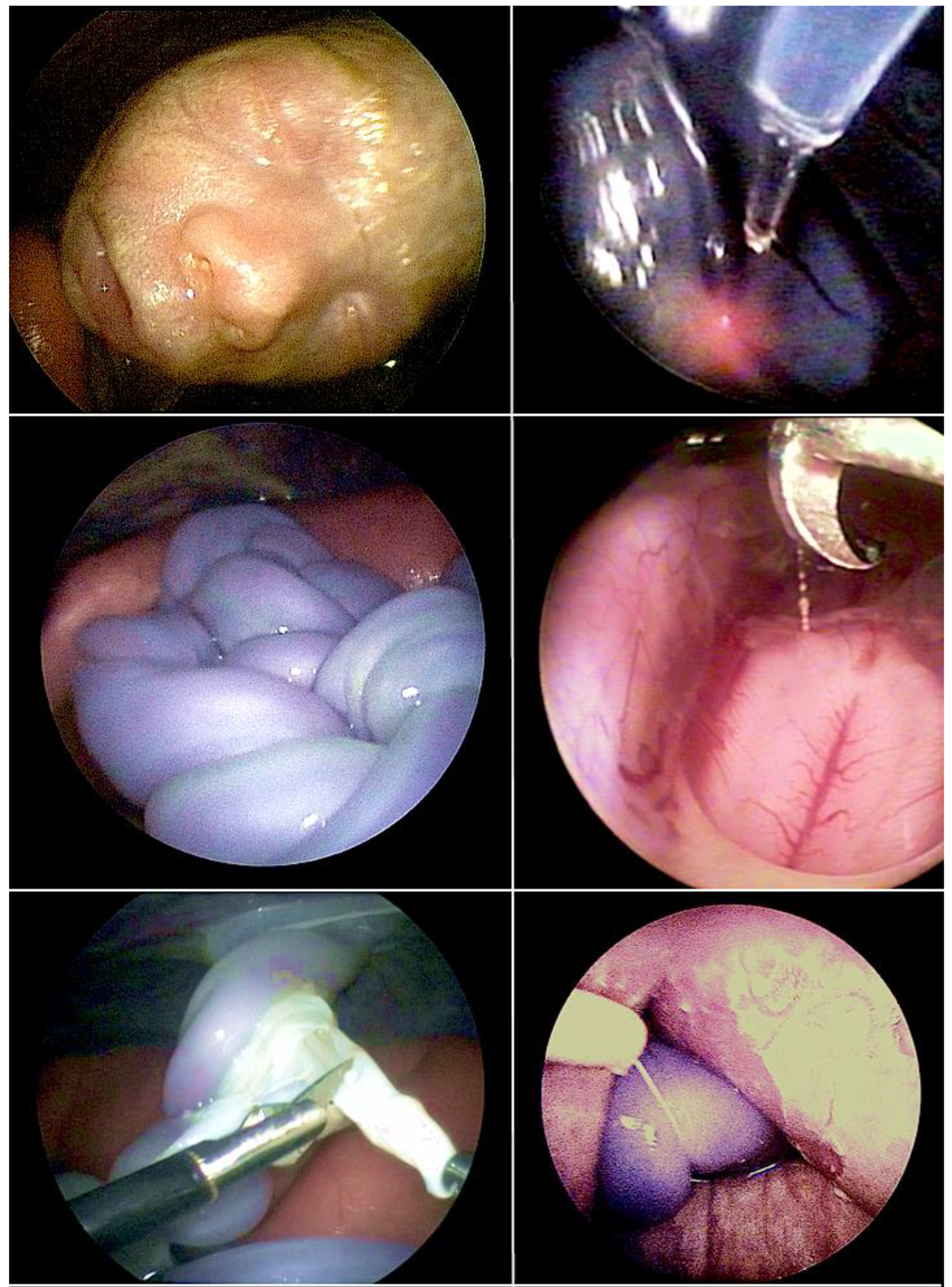 Lifesaving Treatments for the Tiniest Patients—A Narrative Lifesaving Treatments for the Tiniest Patients—A Narrative