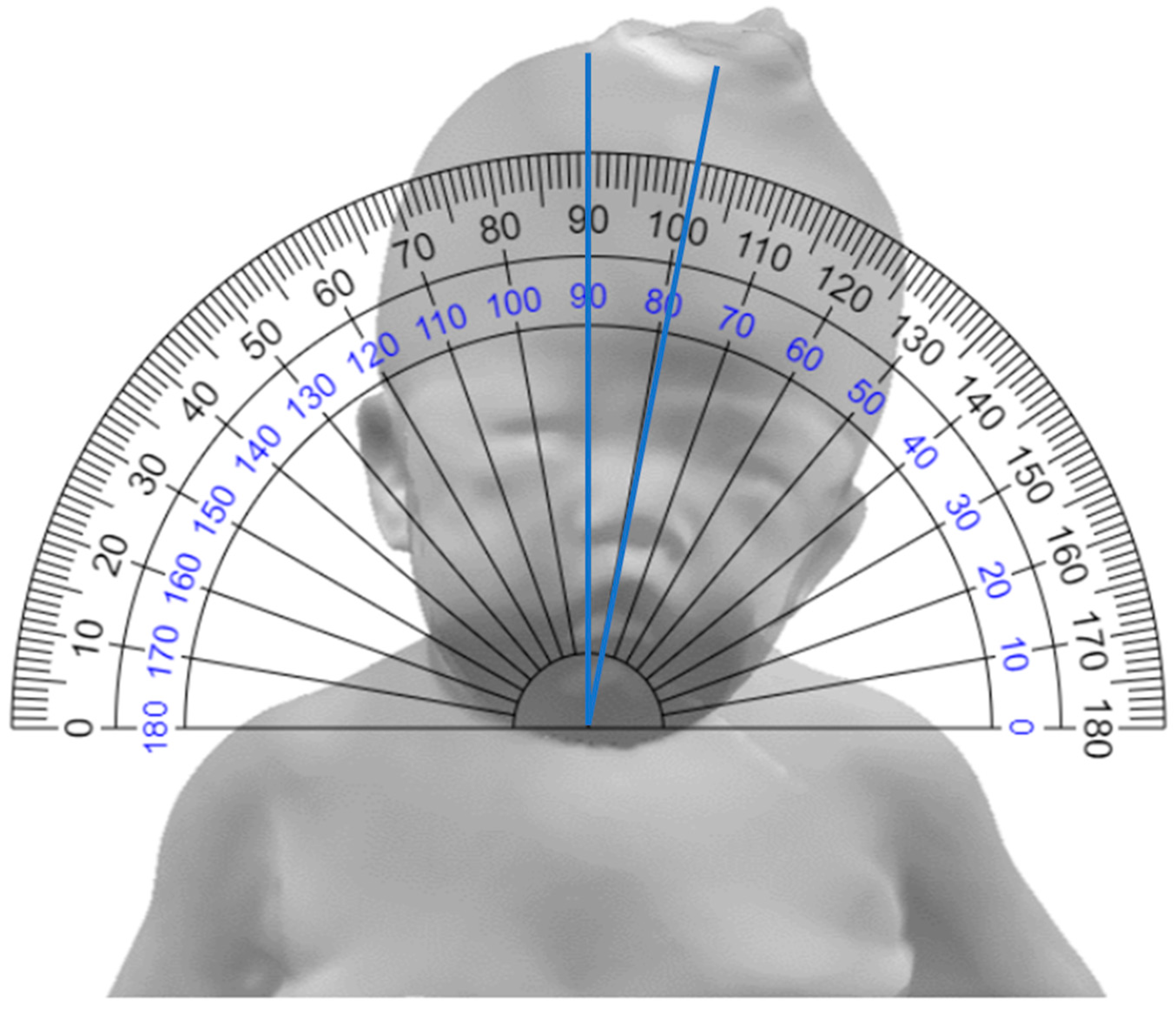 Children Free FullText Quantitative Analysis of the Head Tilt