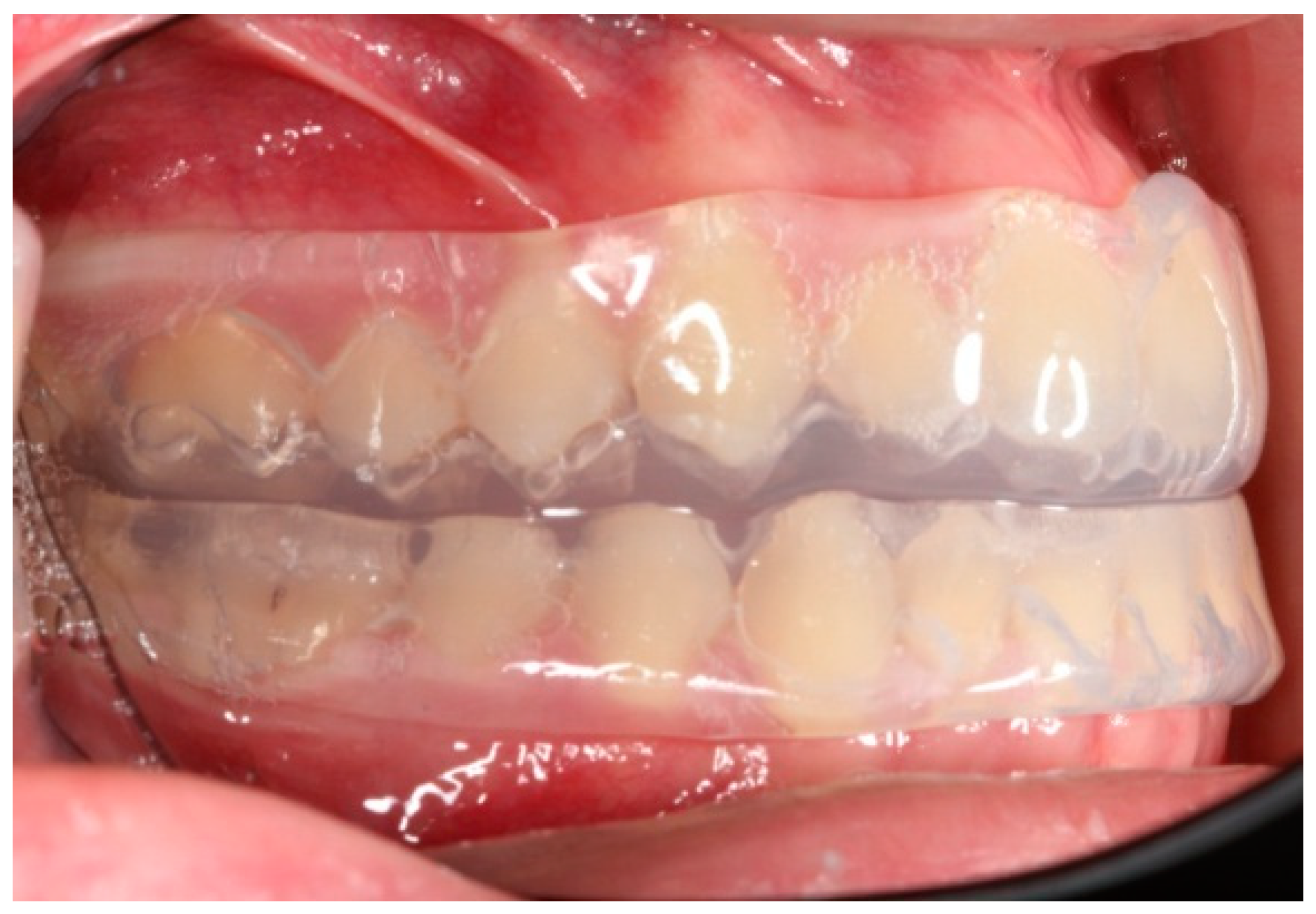 Children Free FullText Orthodontic Retainers—A Critical Review