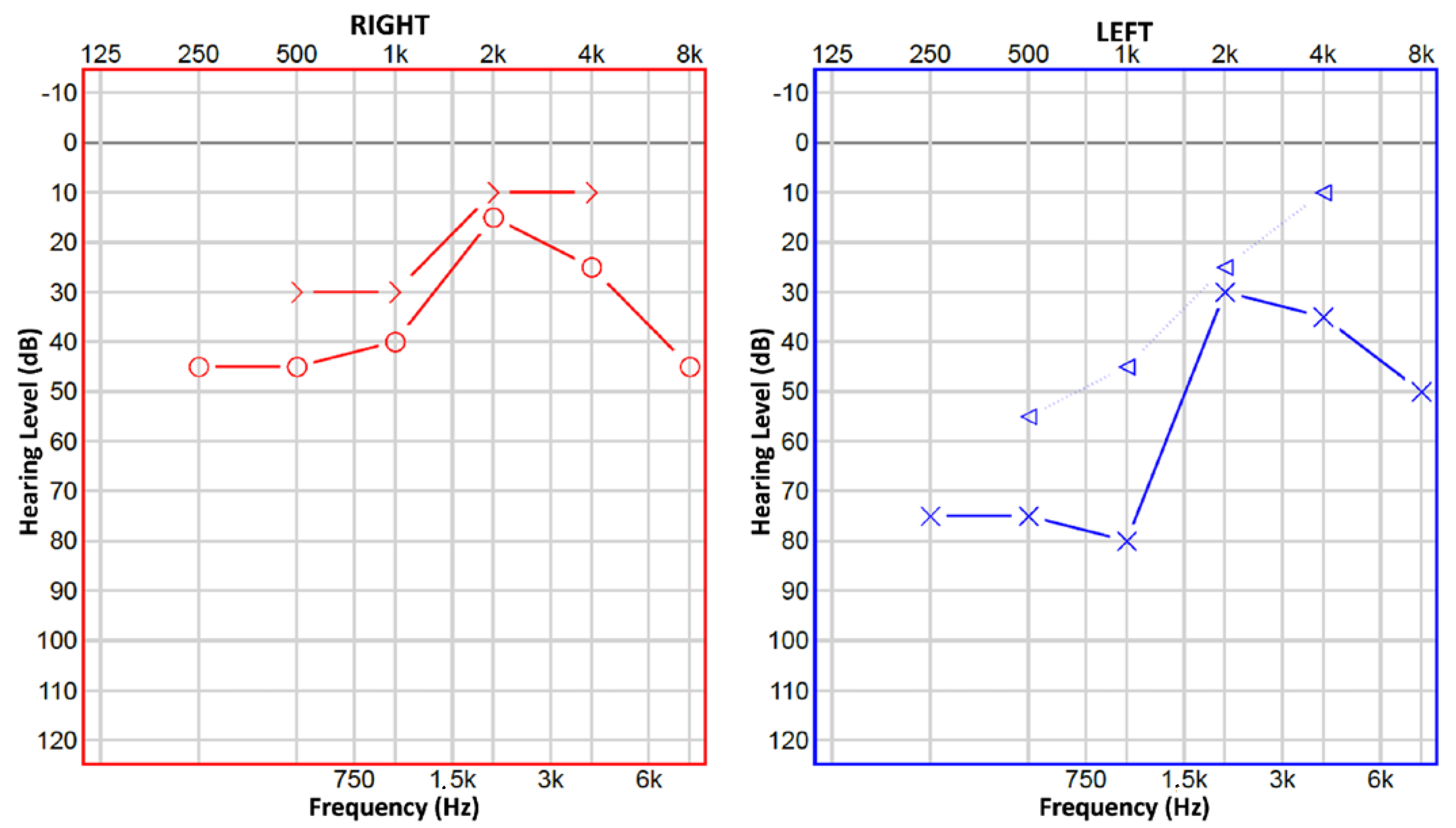 Children Free FullText A Peculiar Case of Ossicular Chain Fixation