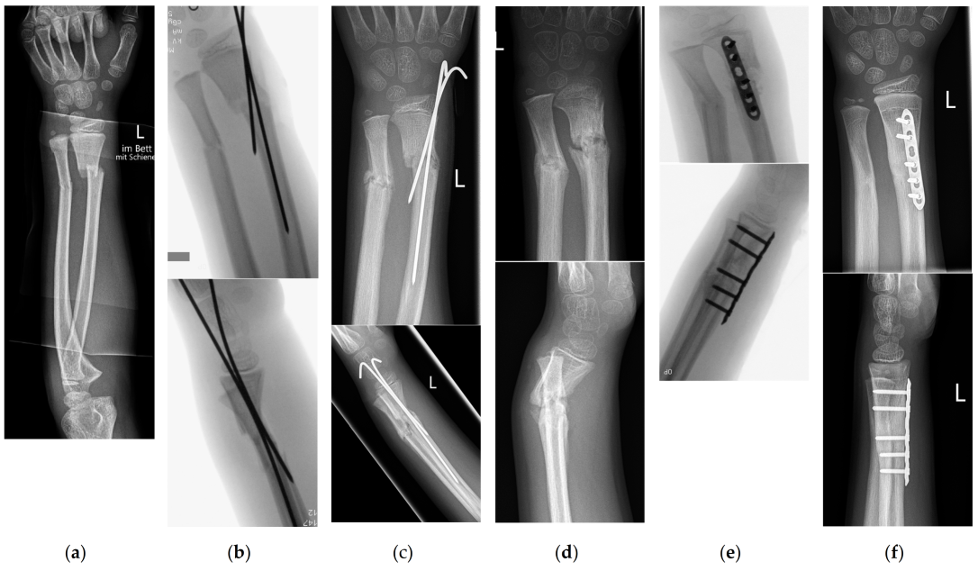 Children 10 00374 g006 Children 10 00374 g006