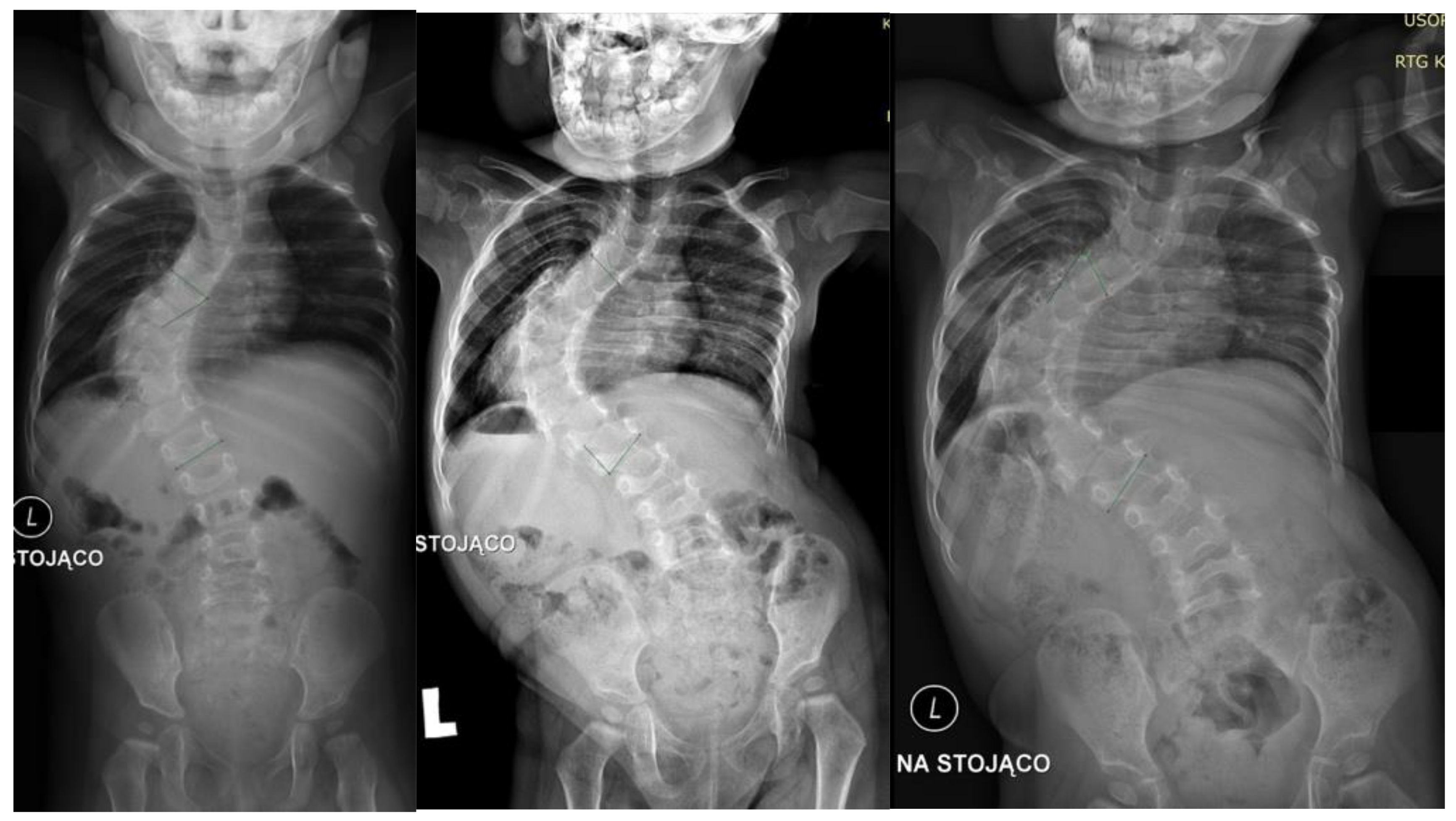Scoliosis X Ray With Rods