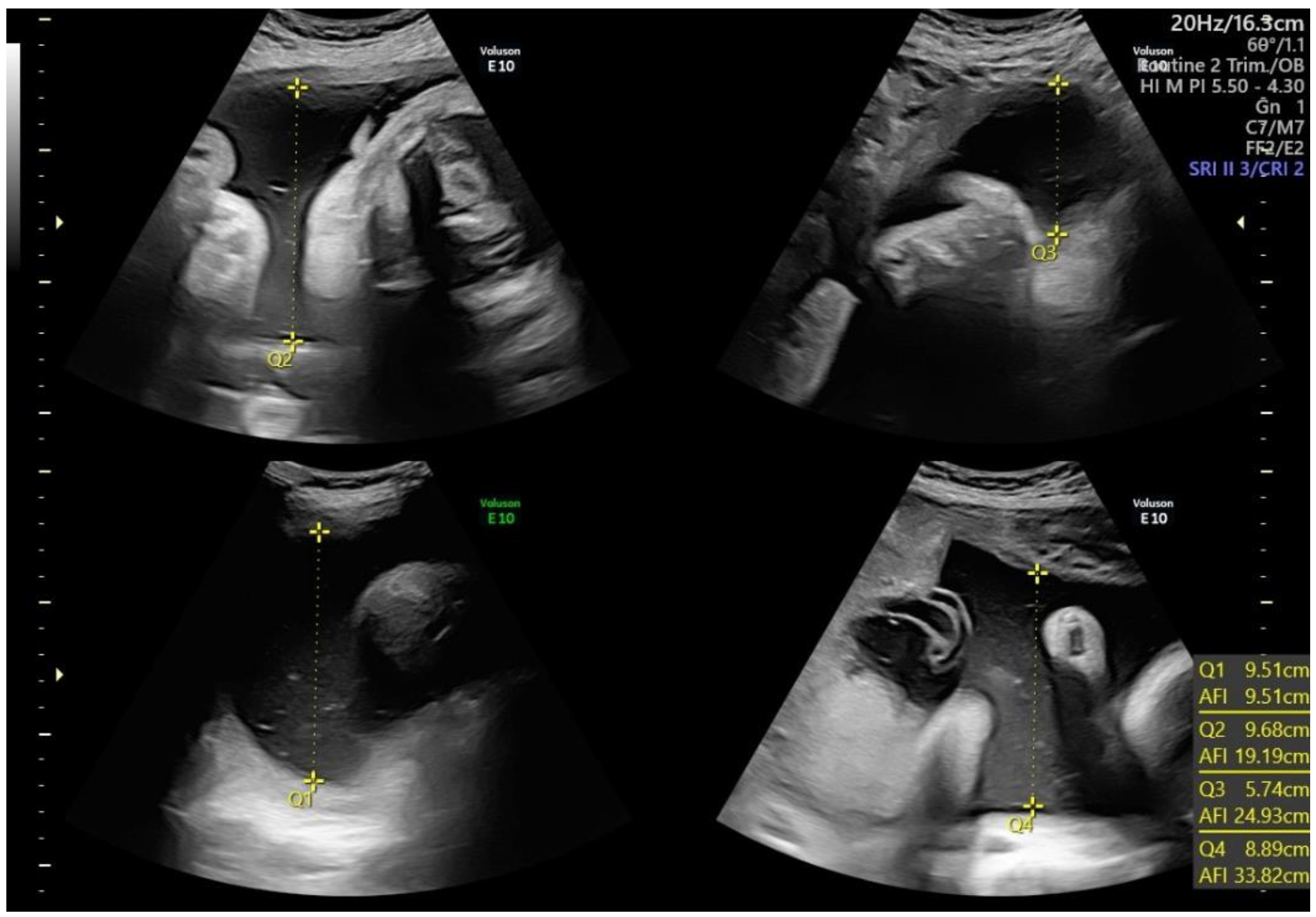 Polyhydramnios Ultrasound polyhydramnios-ultrasound