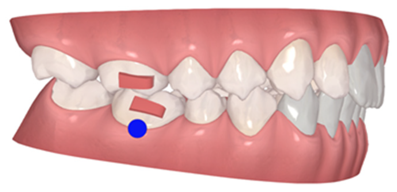 Children Free FullText Scissor Bite in Growing Patients Case