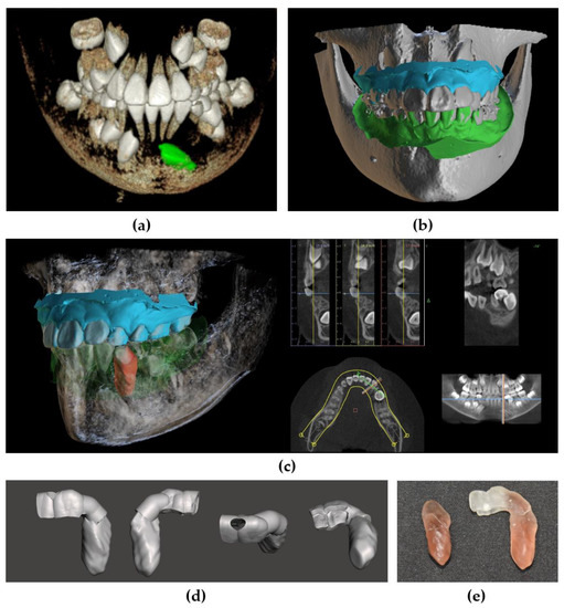 Guided Autotransplantation of Impacted Canines Using a CAD/CAM Surgical ...