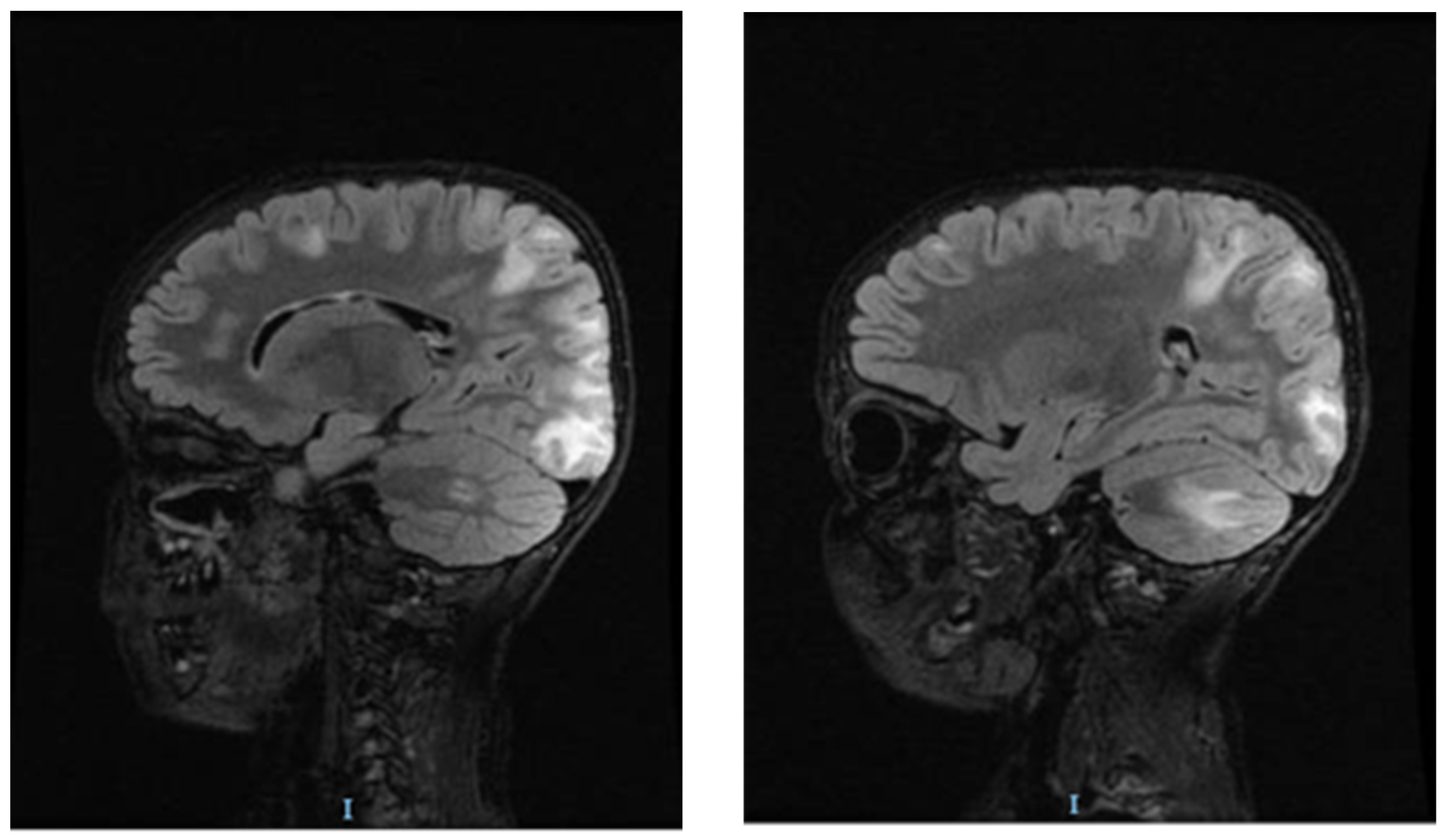 Posterior Reversible Encephalopathy Syndrome in a Pediatric Patient