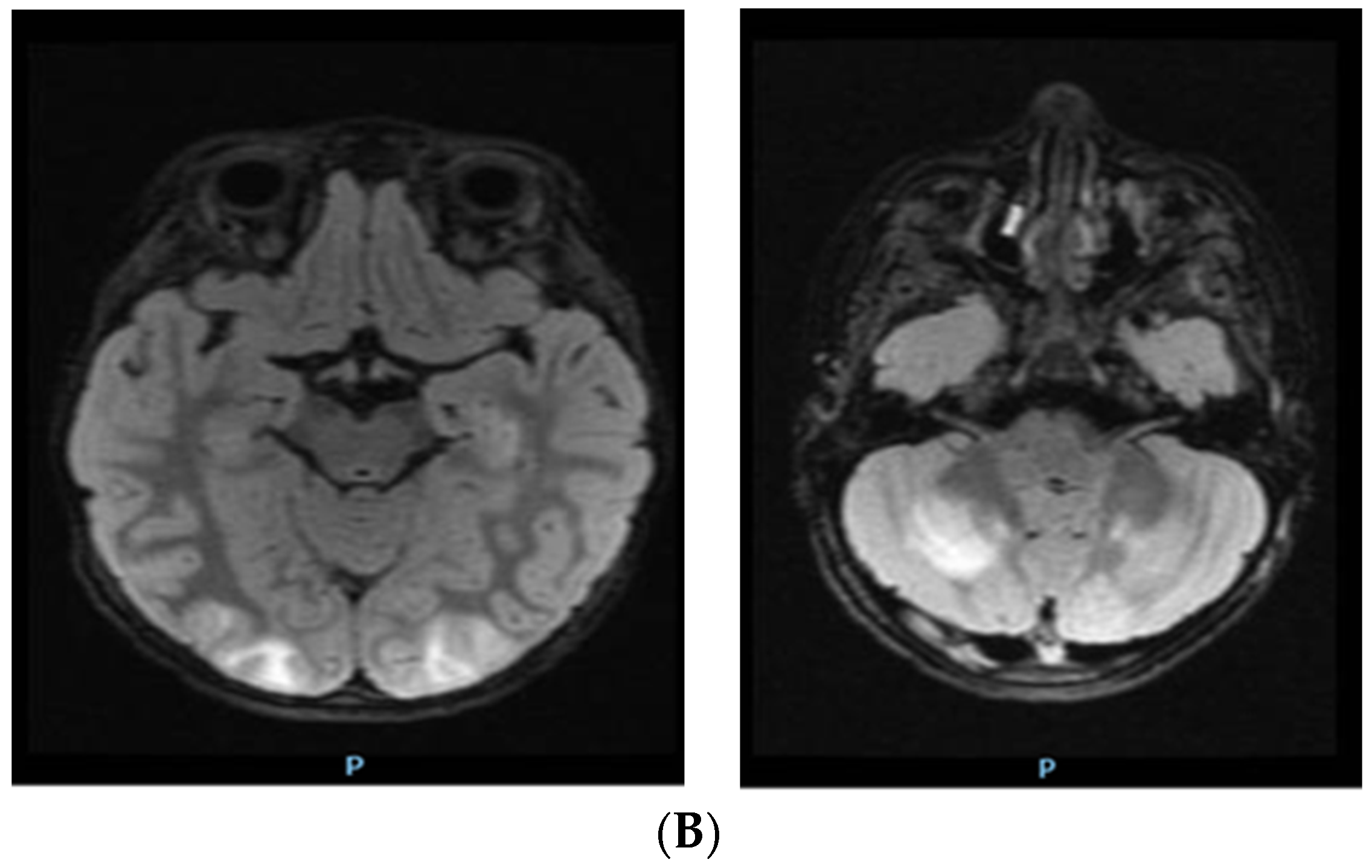 Posterior Reversible Encephalopathy Syndrome in a Pediatric Patient