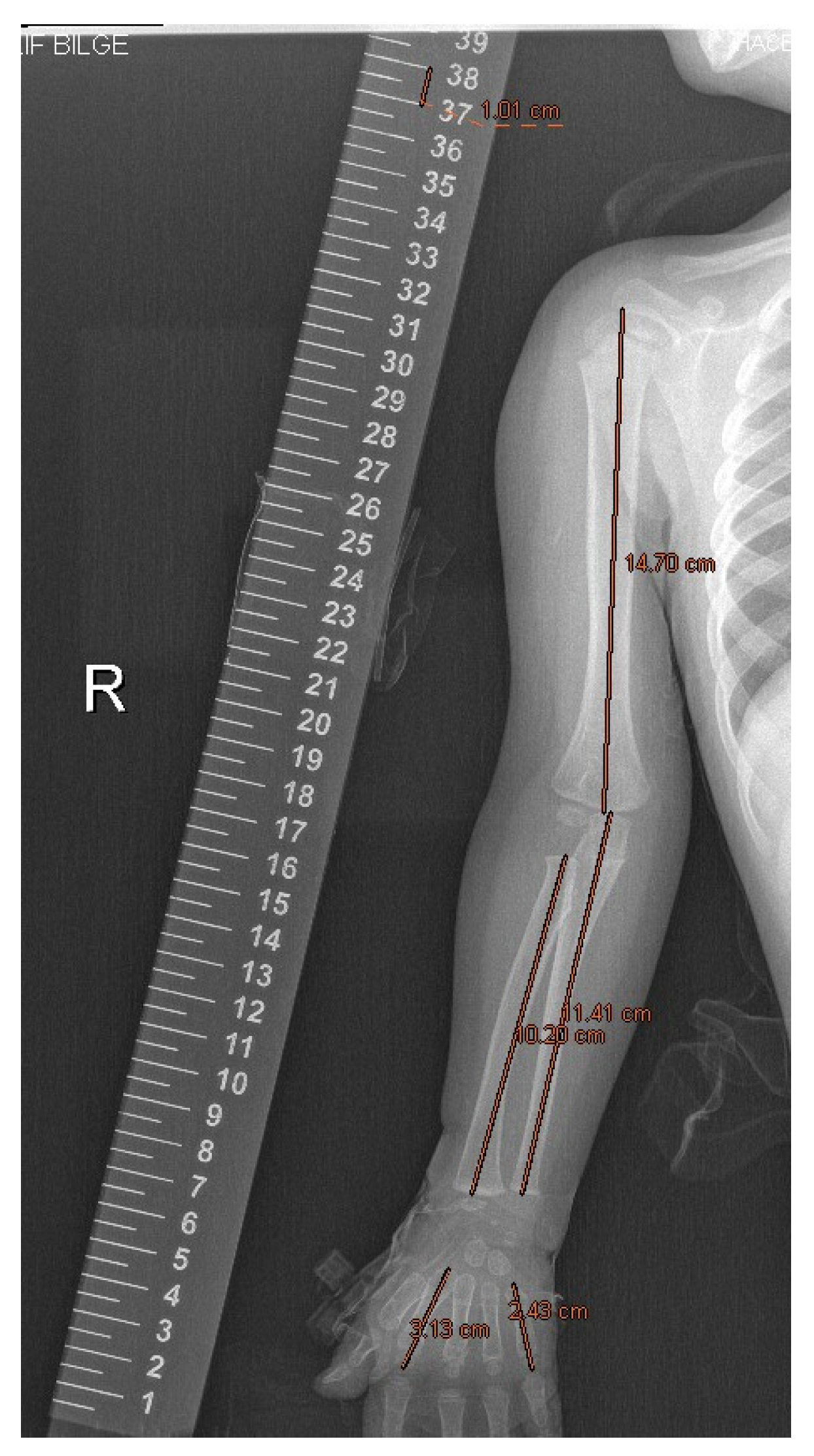 Children Free Full-Text Examination of Upper Extremity Length Discrepancy in Patients with Obstetric Brachial Plexus Paralysis pic