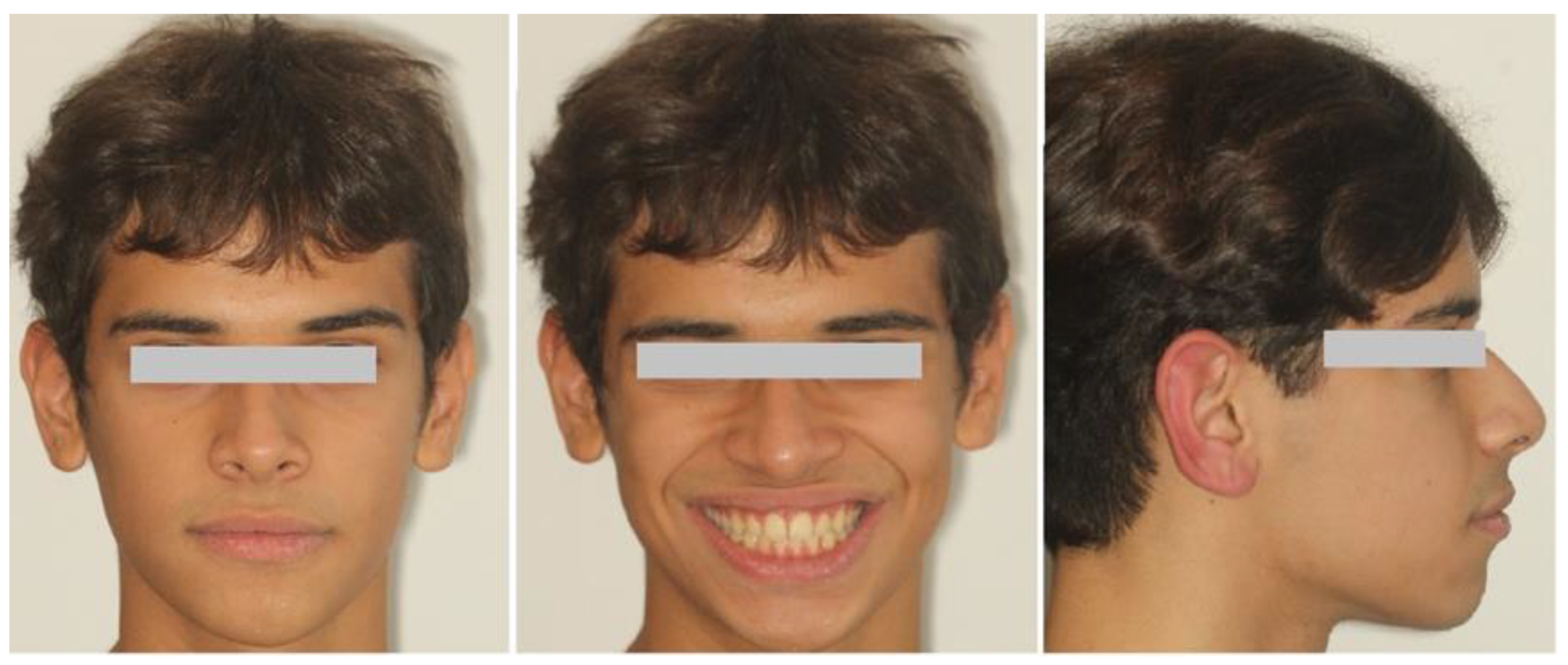 Maxillary Protrusion