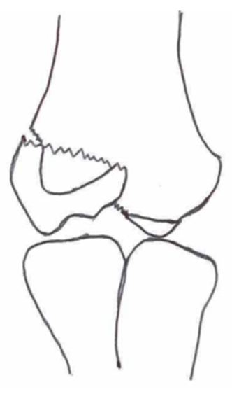 Children 10 01033 i005