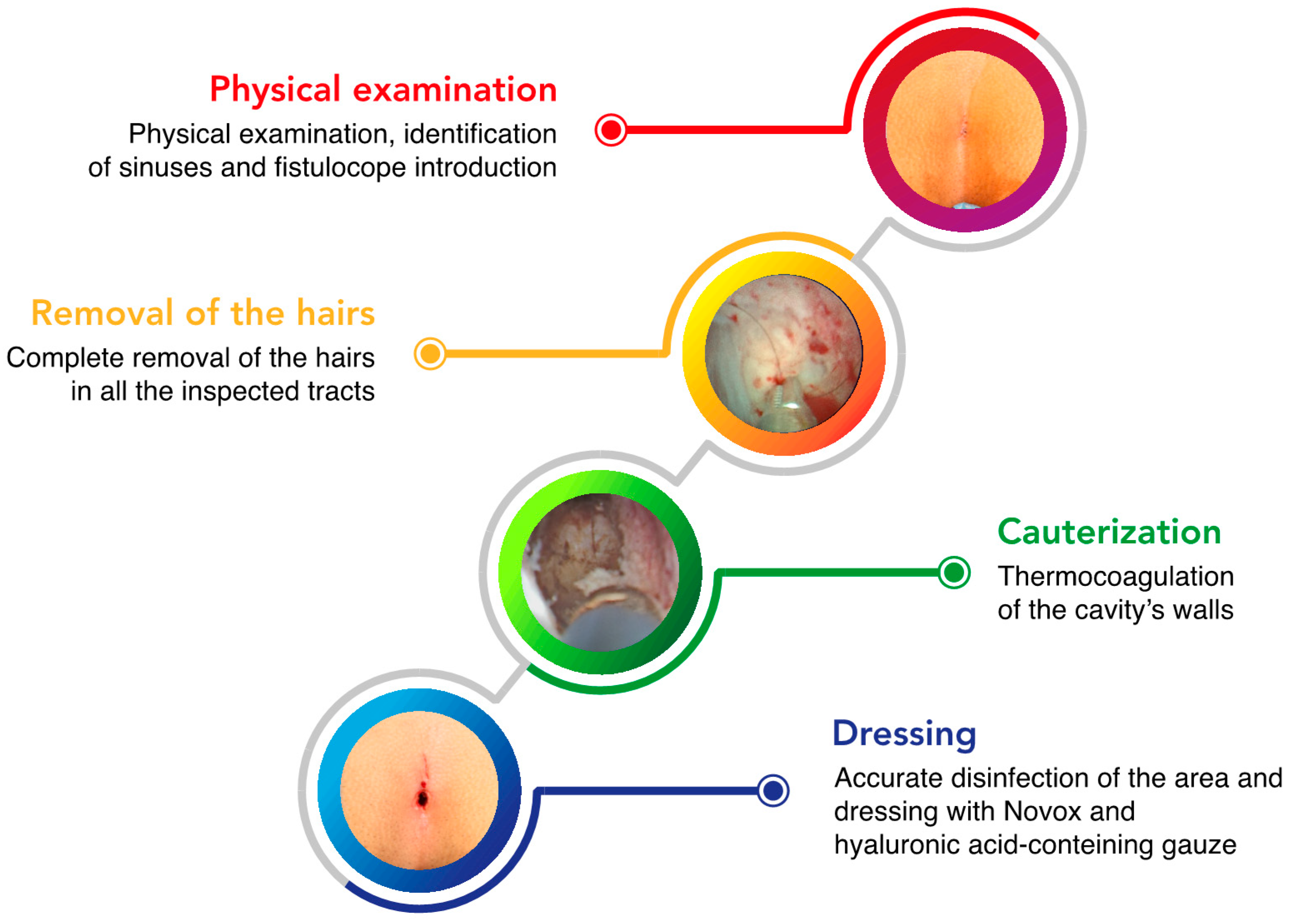 Pros and Cons of each form of Pilonidal Cyst Treatment - Surgery Group LA