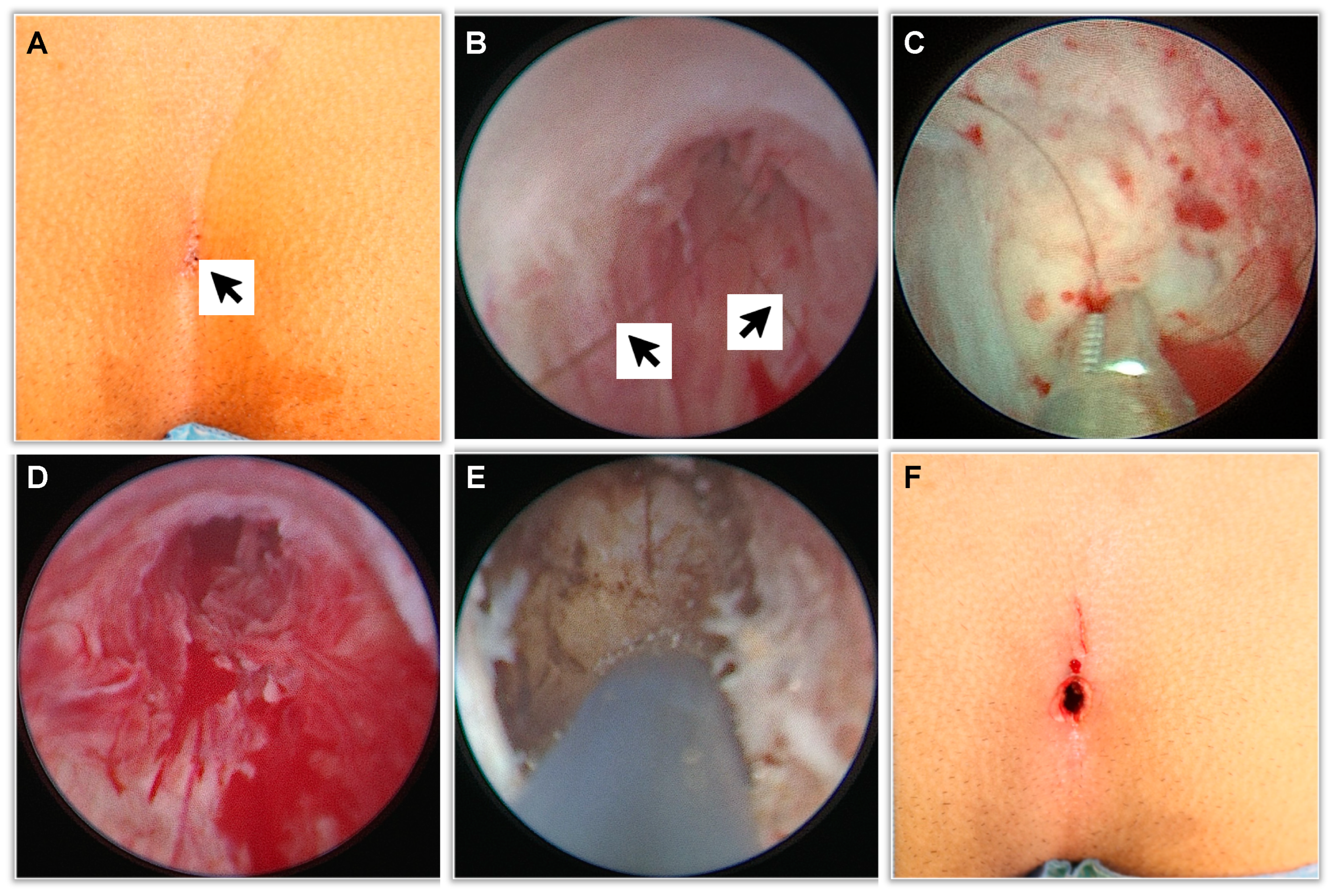 Endoscopic pilonidal sinus treatment (E.P.Si.T.): a minimally invasive  approach - ScienceDirect