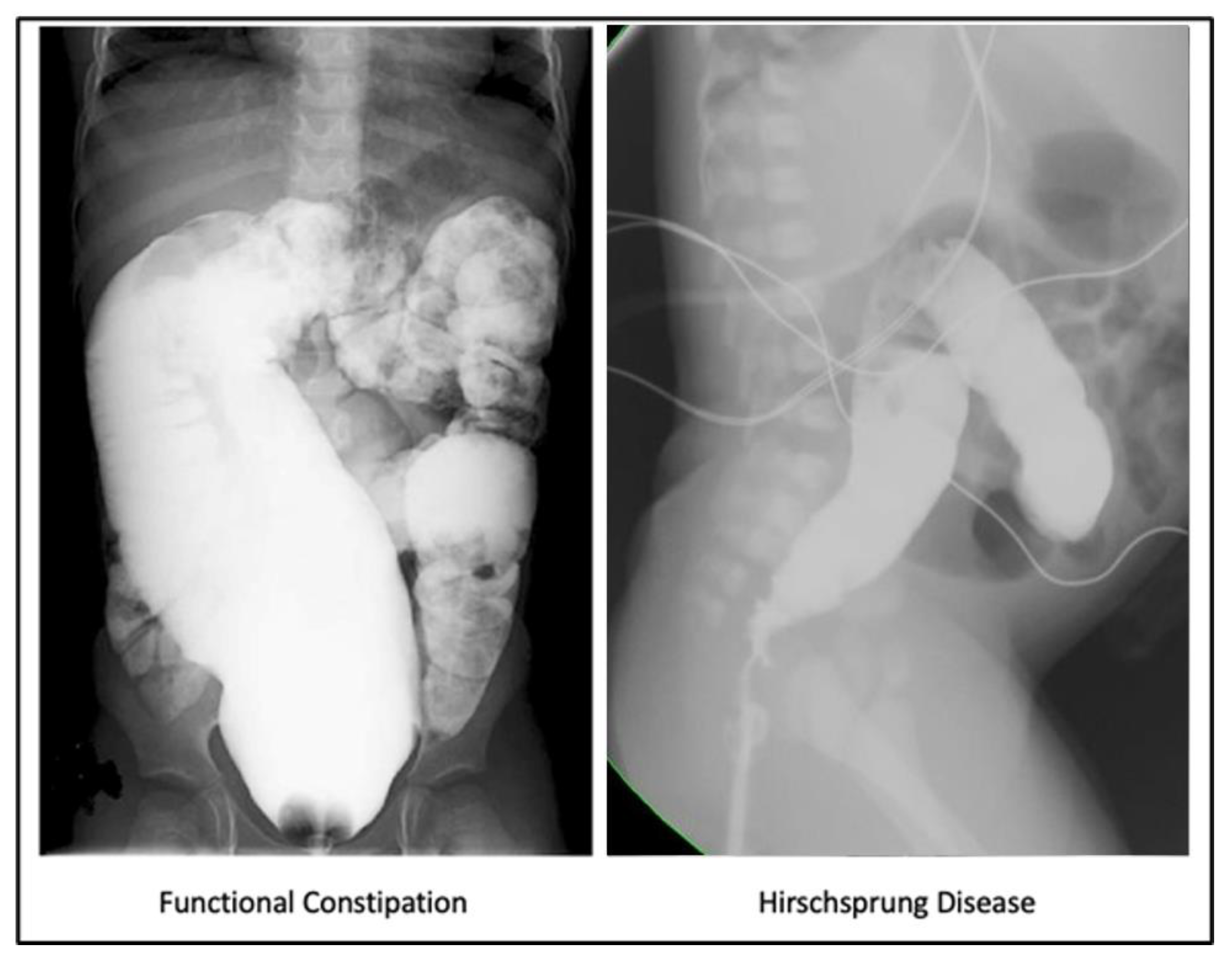 Faecal impaction with overflow