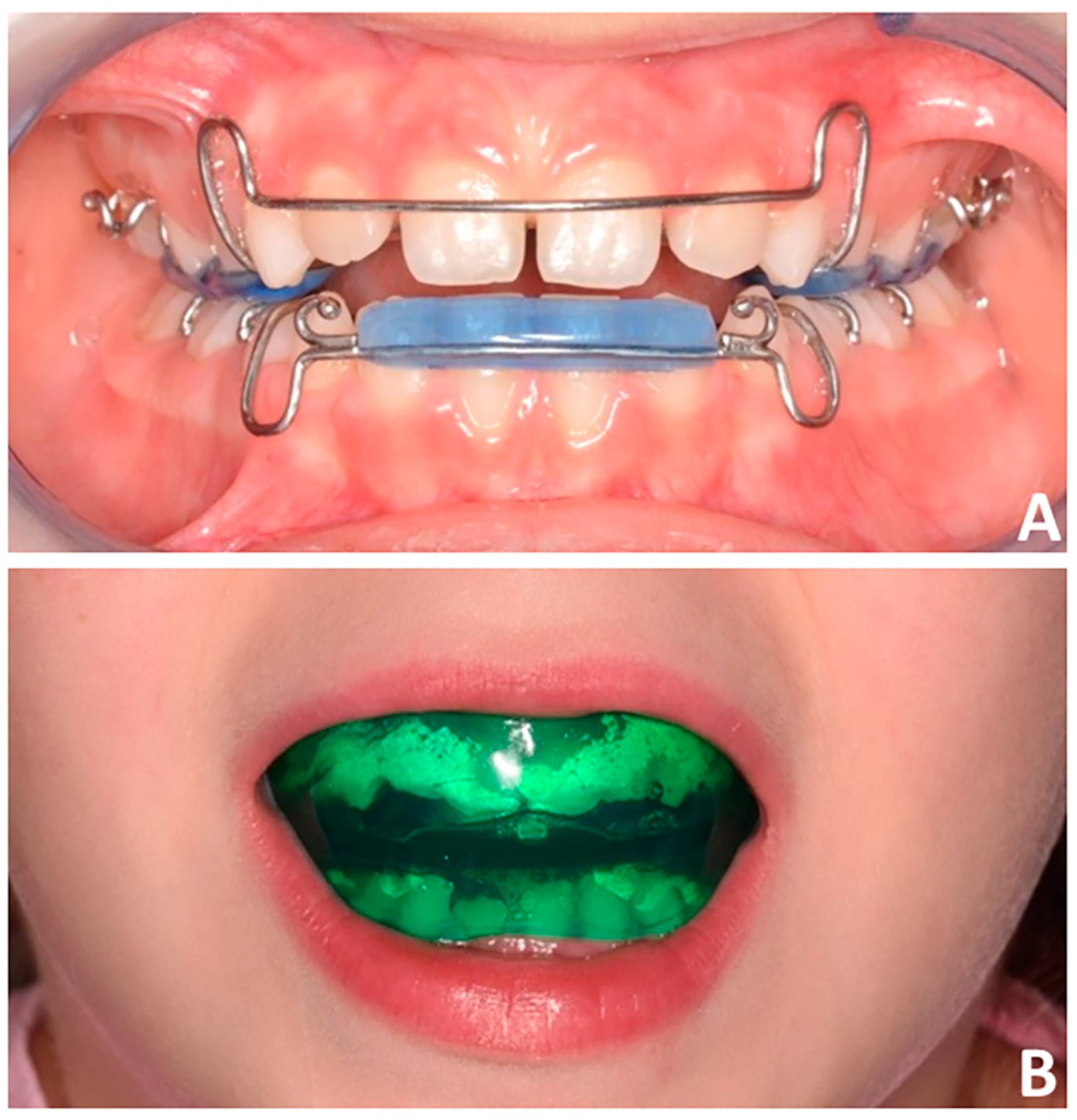 Comparative Analysis of Skeletal Changes, Occlusal Changes