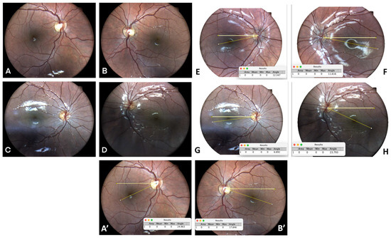 Liu, Volpe, and Galetta's Neuro-Ophthalmology: Diagnosis and