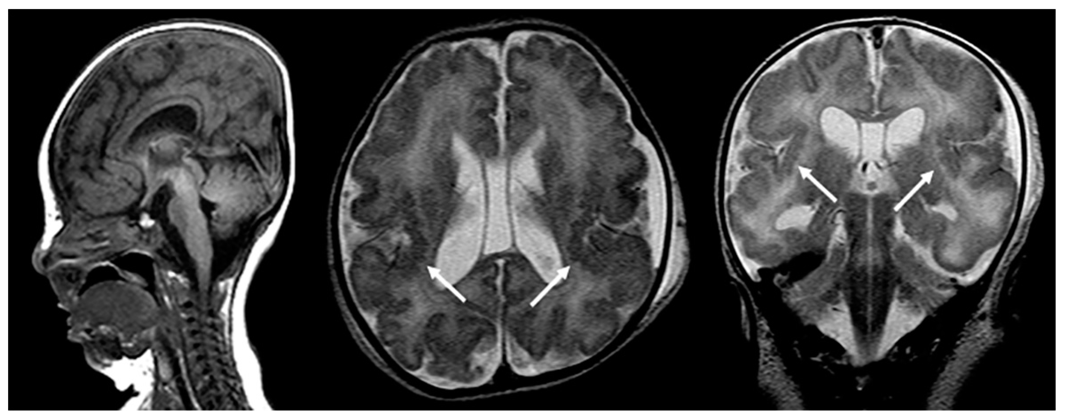 Figure 2. [Broad terminal phalanges (A) and broad, radially deviated thumbs  (B)]. - GeneReviews® - NCBI Bookshelf