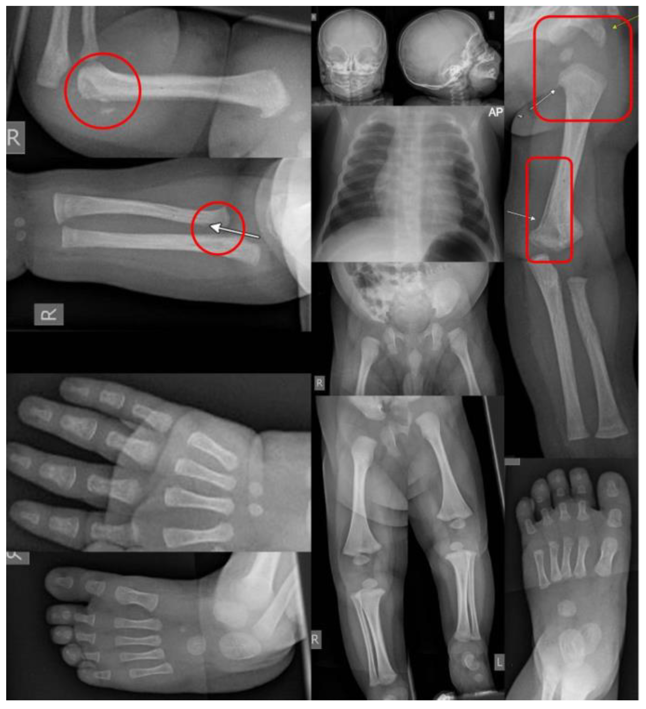 Identification and Evaluation of NonAccidental Trauma in the Pediatric