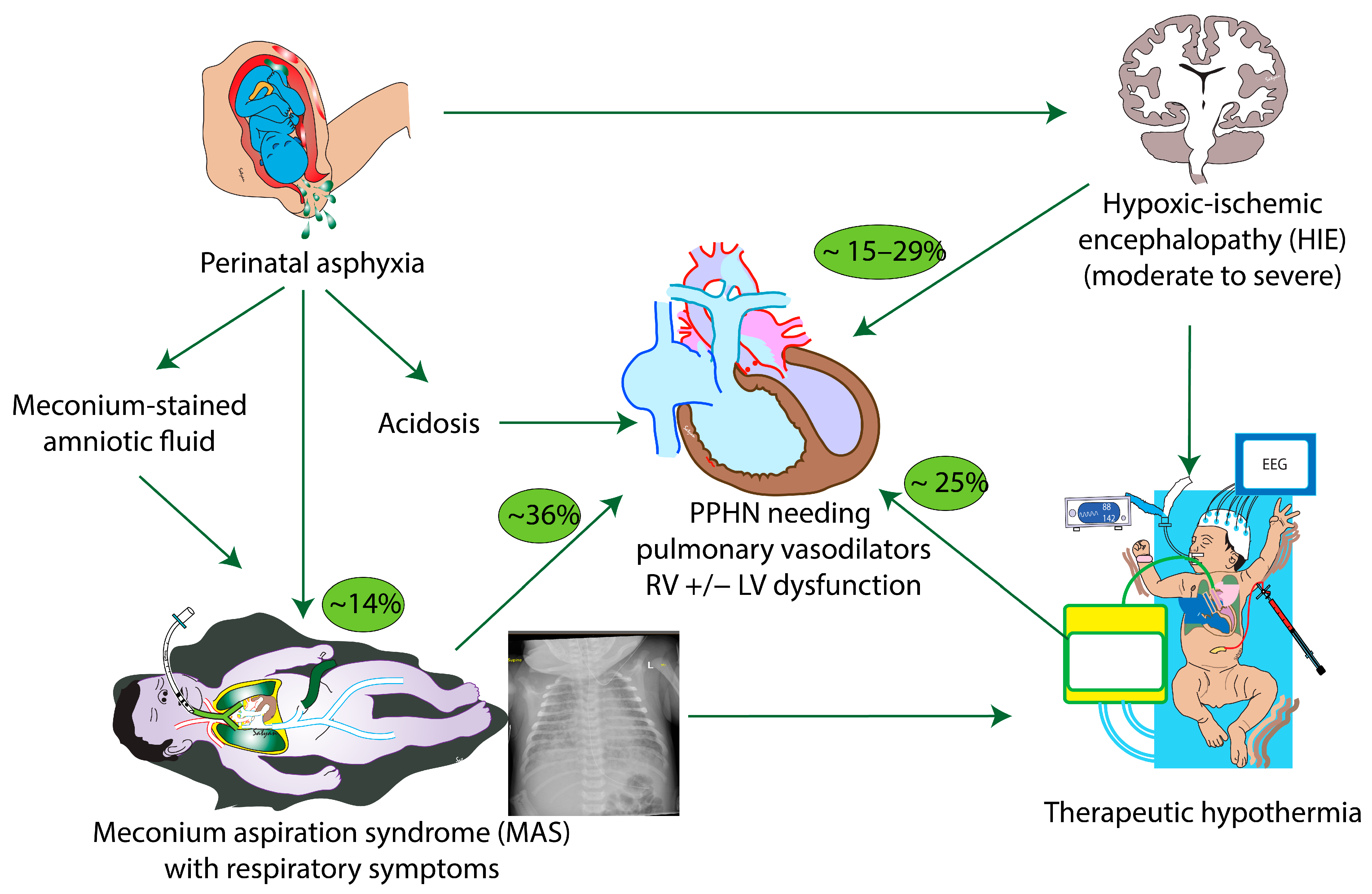 Meconium Aspiration Syndrome, Hypoxic-Ischemic Encephalopathy and ...