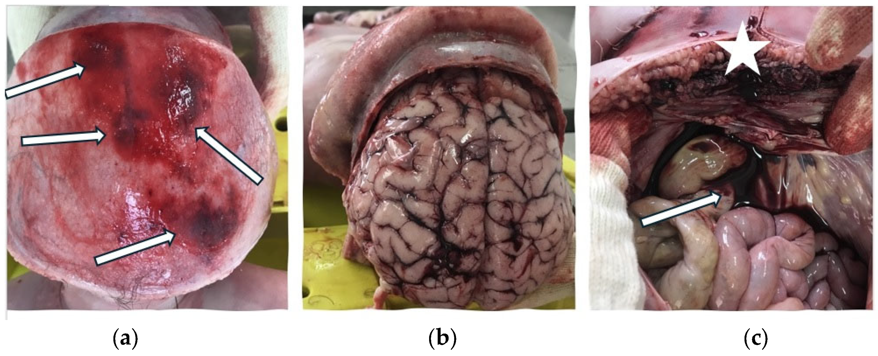 autopsy child  Road Fatalities in Children Aged 0–17: Epidemiological Data and Forensic  Aspects on a Series of Cases in a Single-Centre in Romania