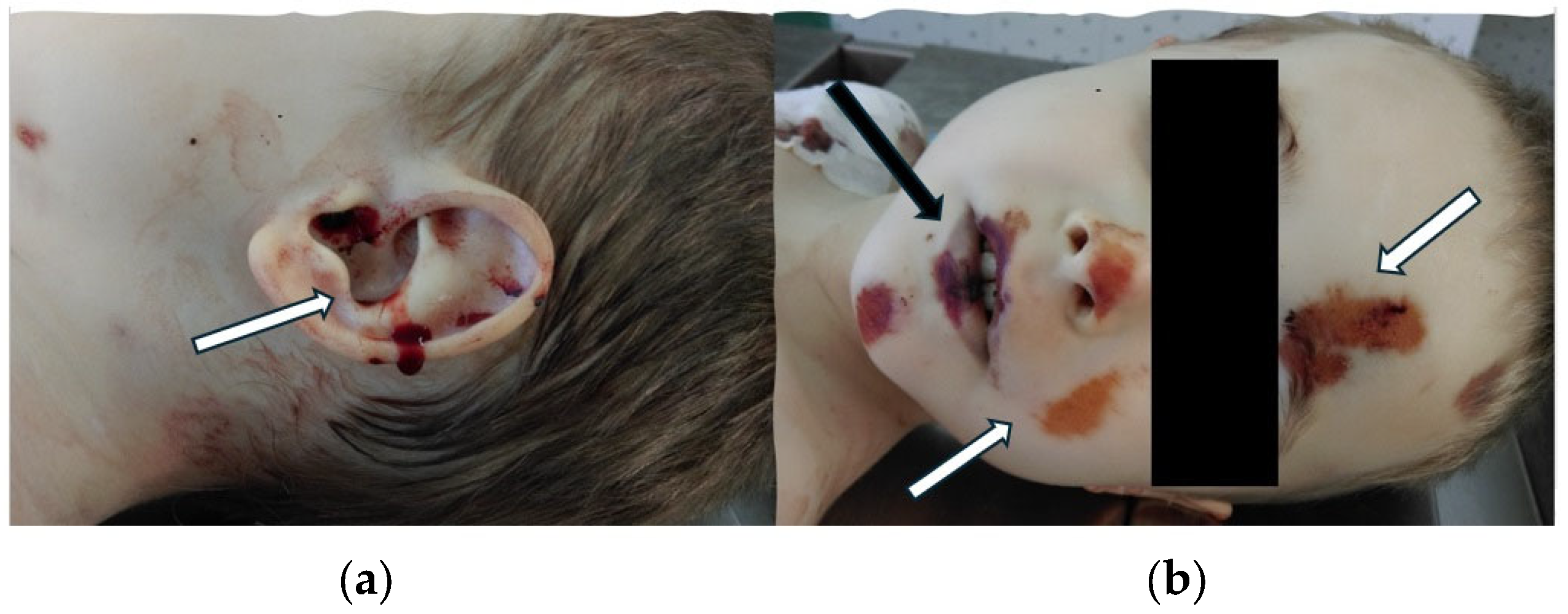 autopsy child  Road Fatalities in Children Aged 0–17: Epidemiological Data and Forensic  Aspects on a Series of Cases in a Single-Centre in Romania