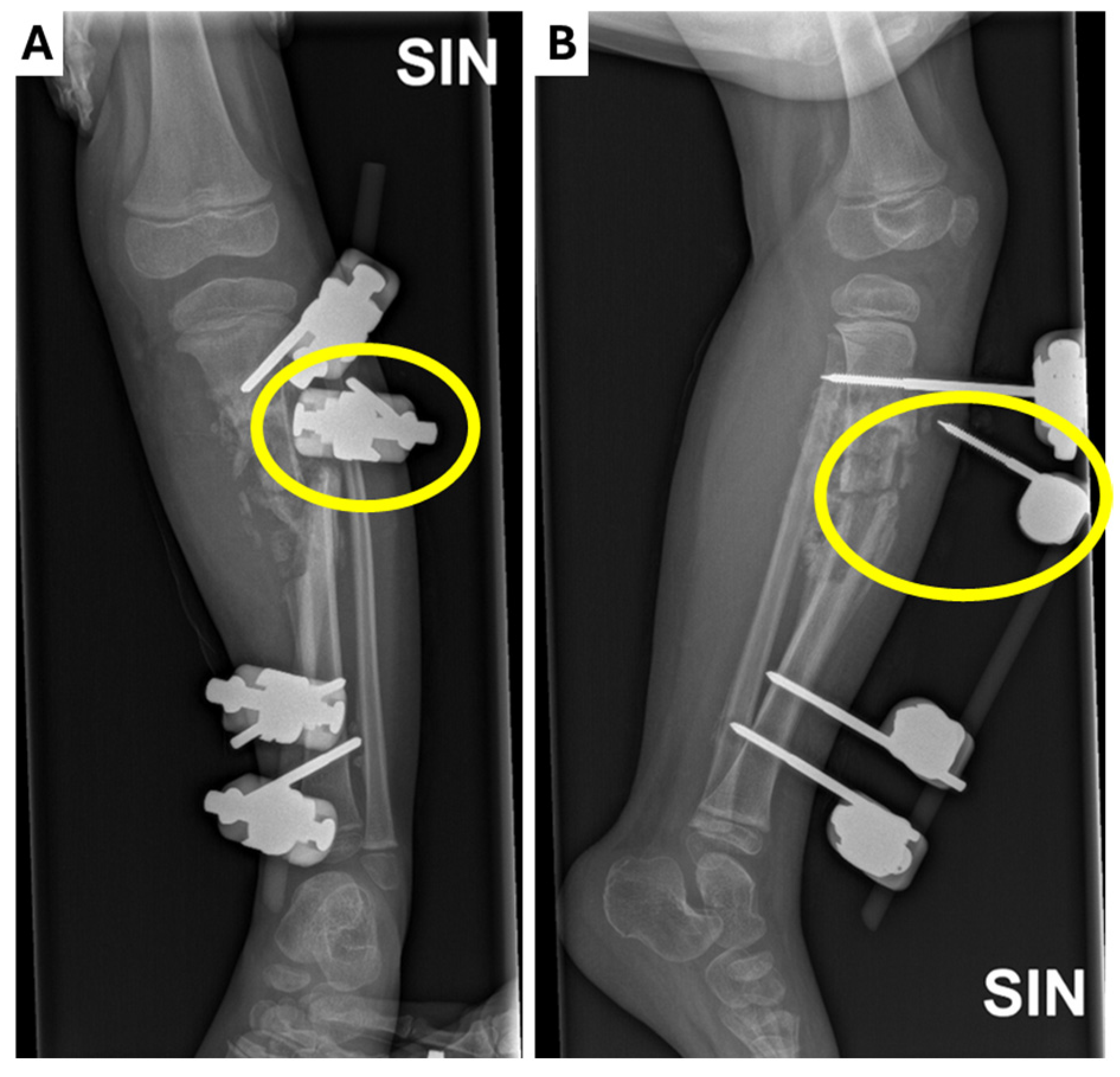 Recurrent Osteomyelitis in a Paediatric Patient with a Novel