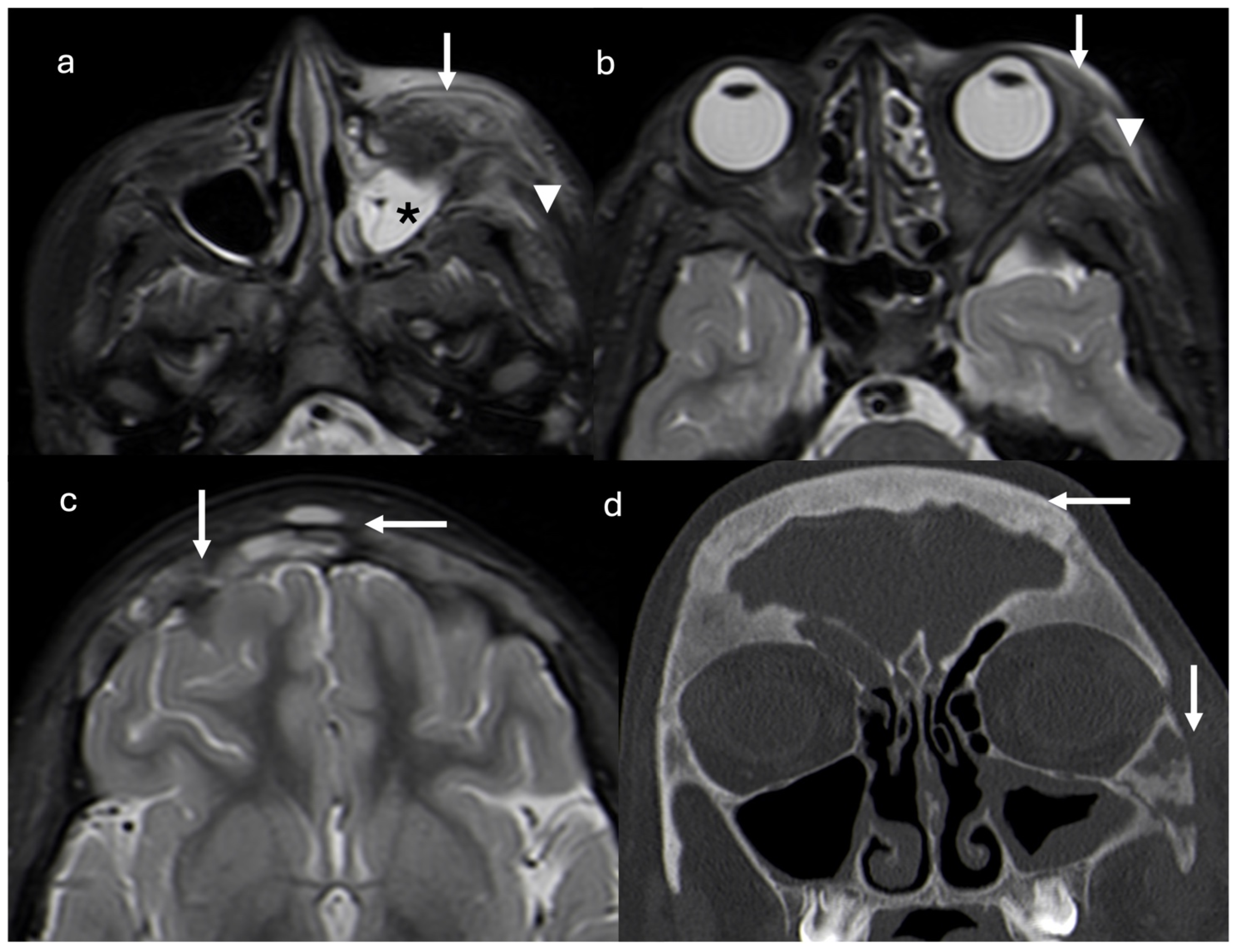 IgG4-Related Disease in Childhood: Clinical Presentation