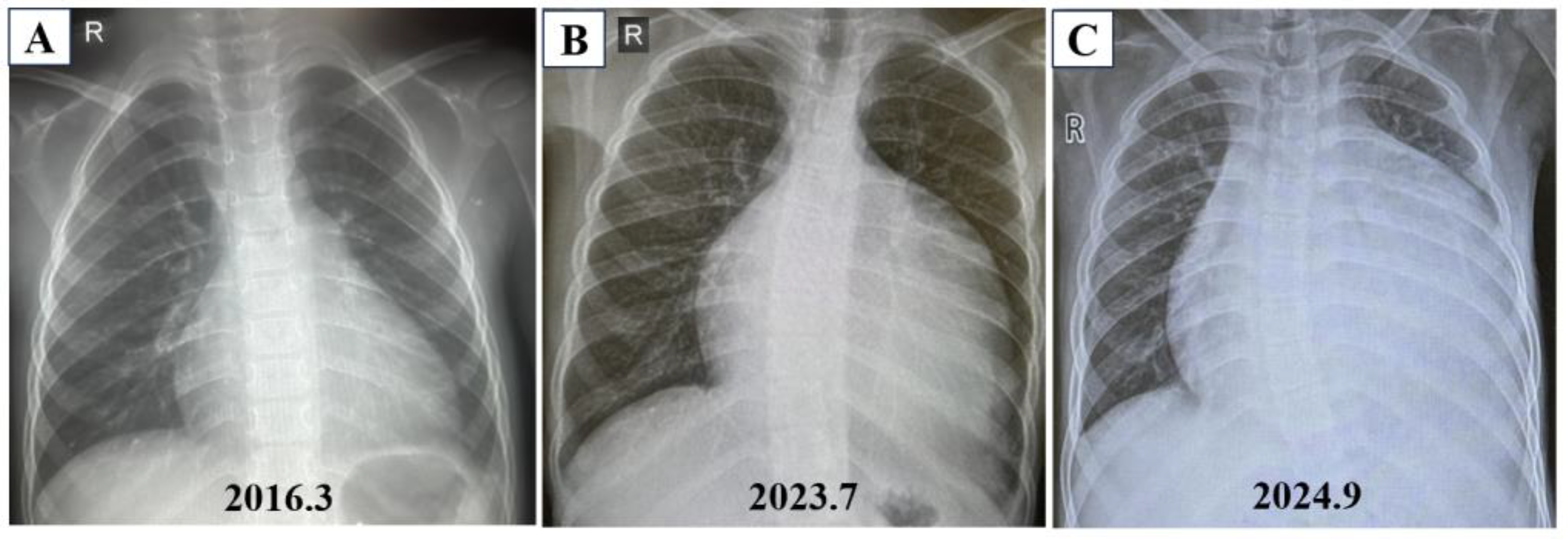 A Rare Case of Multi-System Involvement and Hereditary Pulmonary
