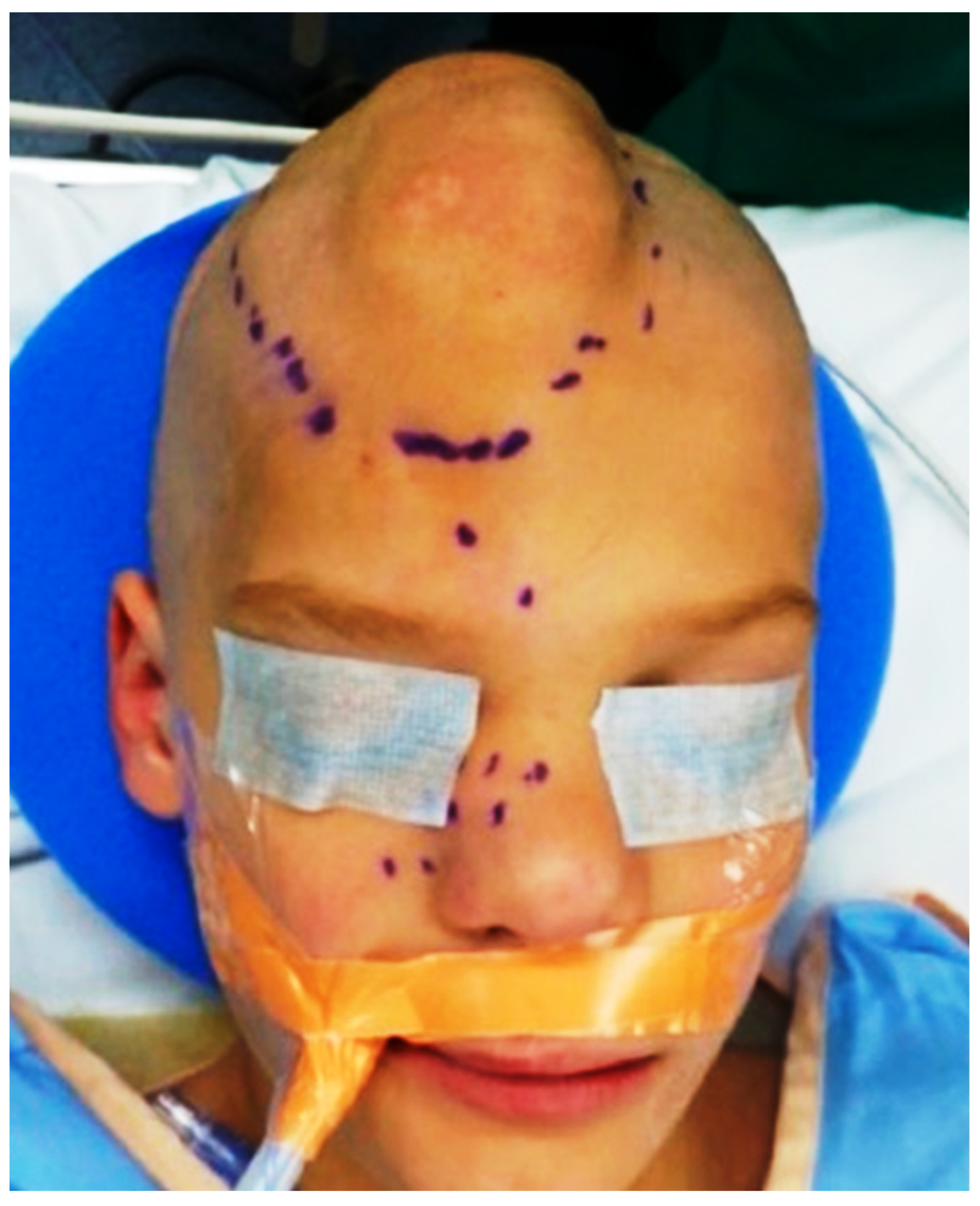 Recurrent PIK3CA H1047R-Mutated Congenital Infiltrative