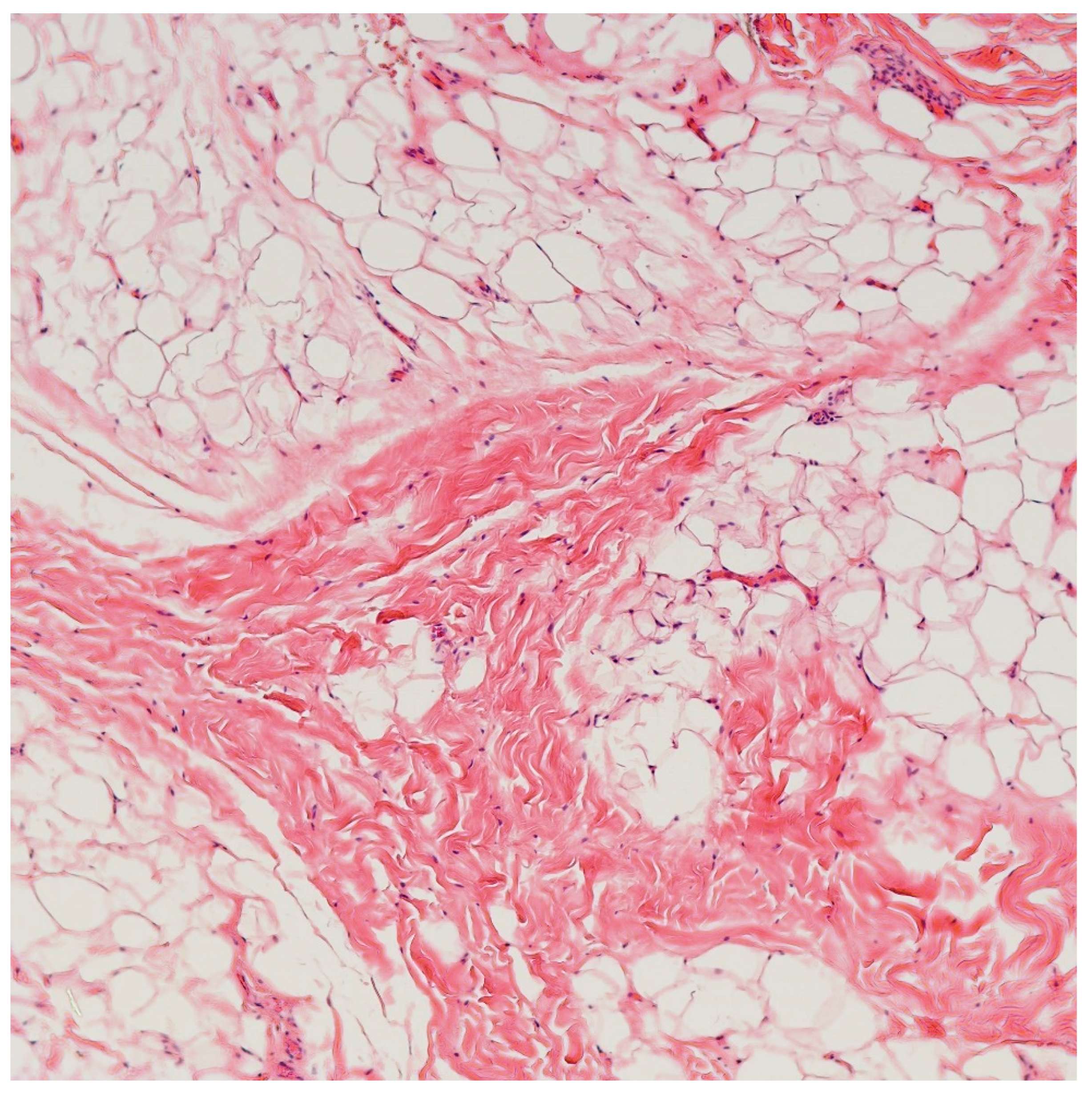 Recurrent PIK3CA H1047R-Mutated Congenital Infiltrative