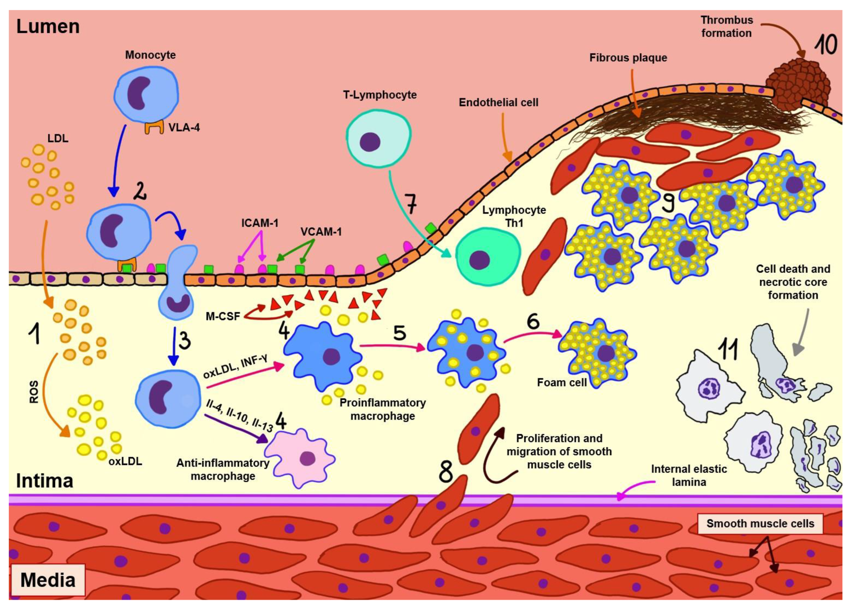 Major Study of Atherosclerotic Plaque Deposits Shows Potential Breakthrough  in Determining Risk for Heart Attacks