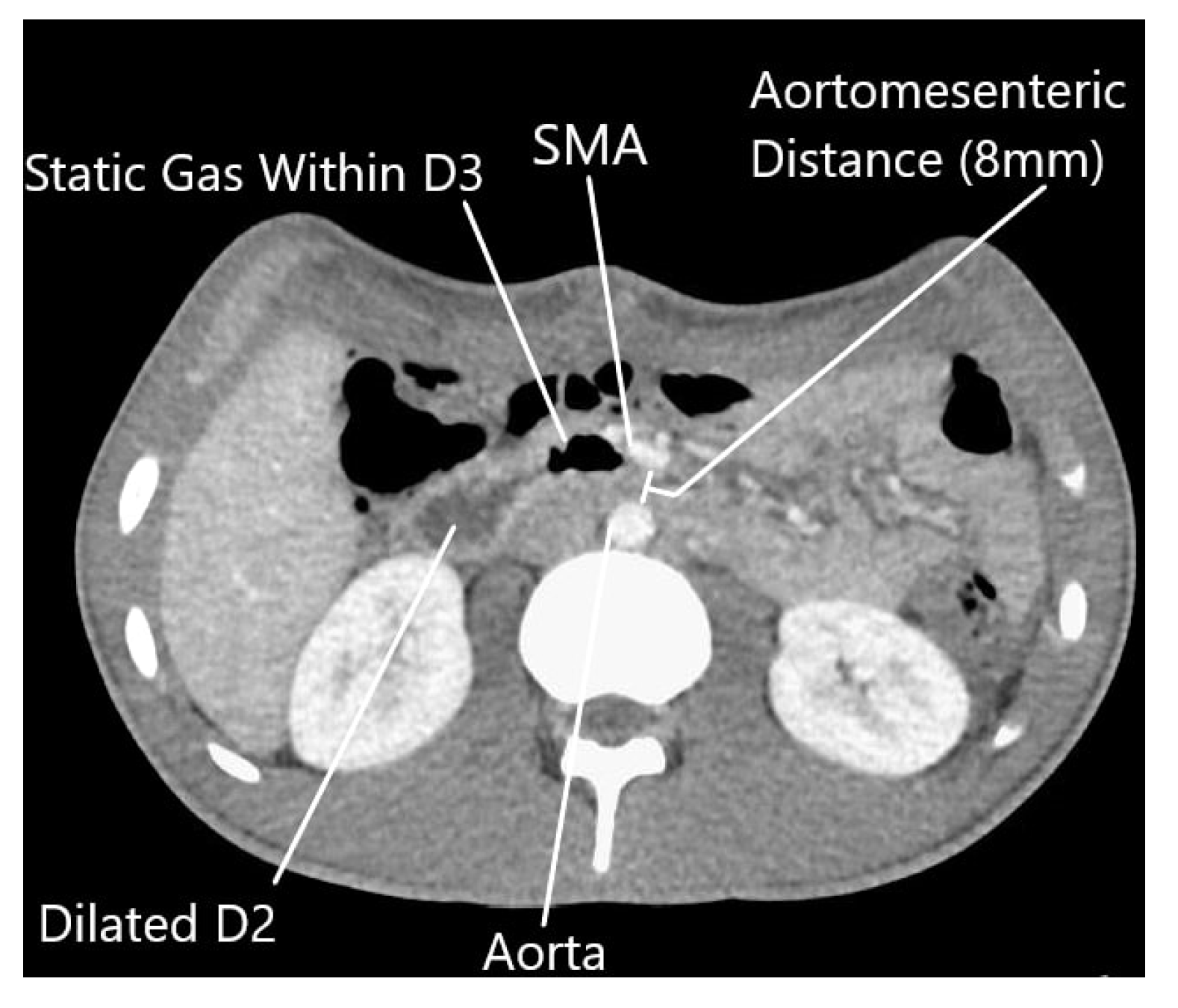 Superior Mesenteric Artery Syndrome