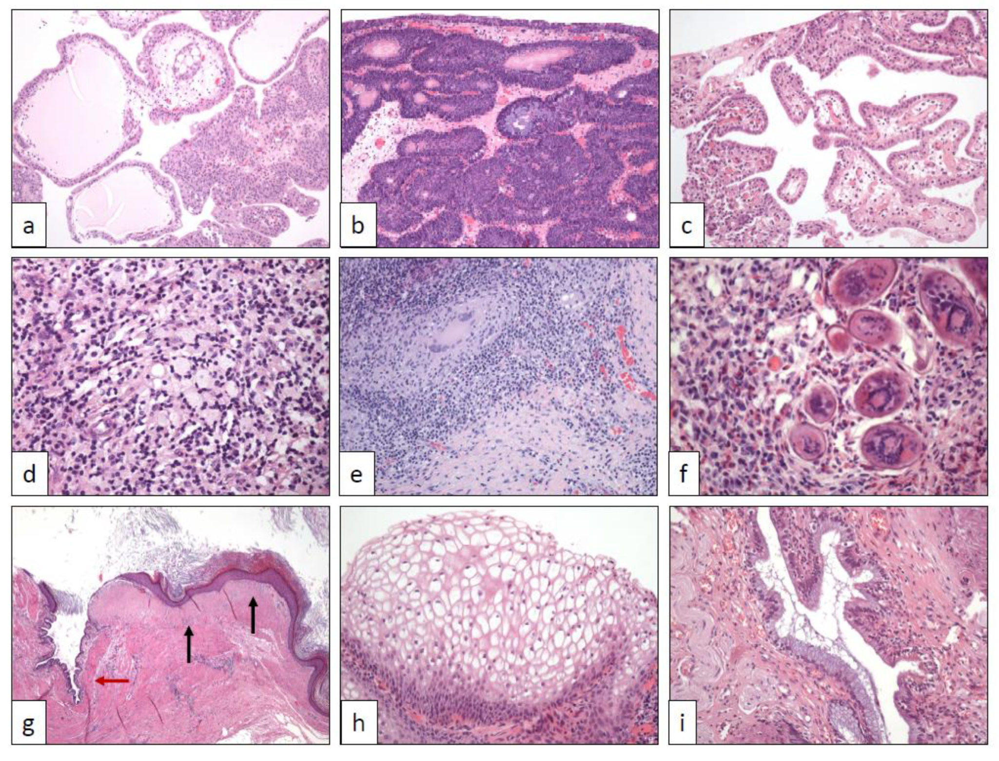 Inverted urothelial papilloma immunohistochemistry, Adenom papilla di vater