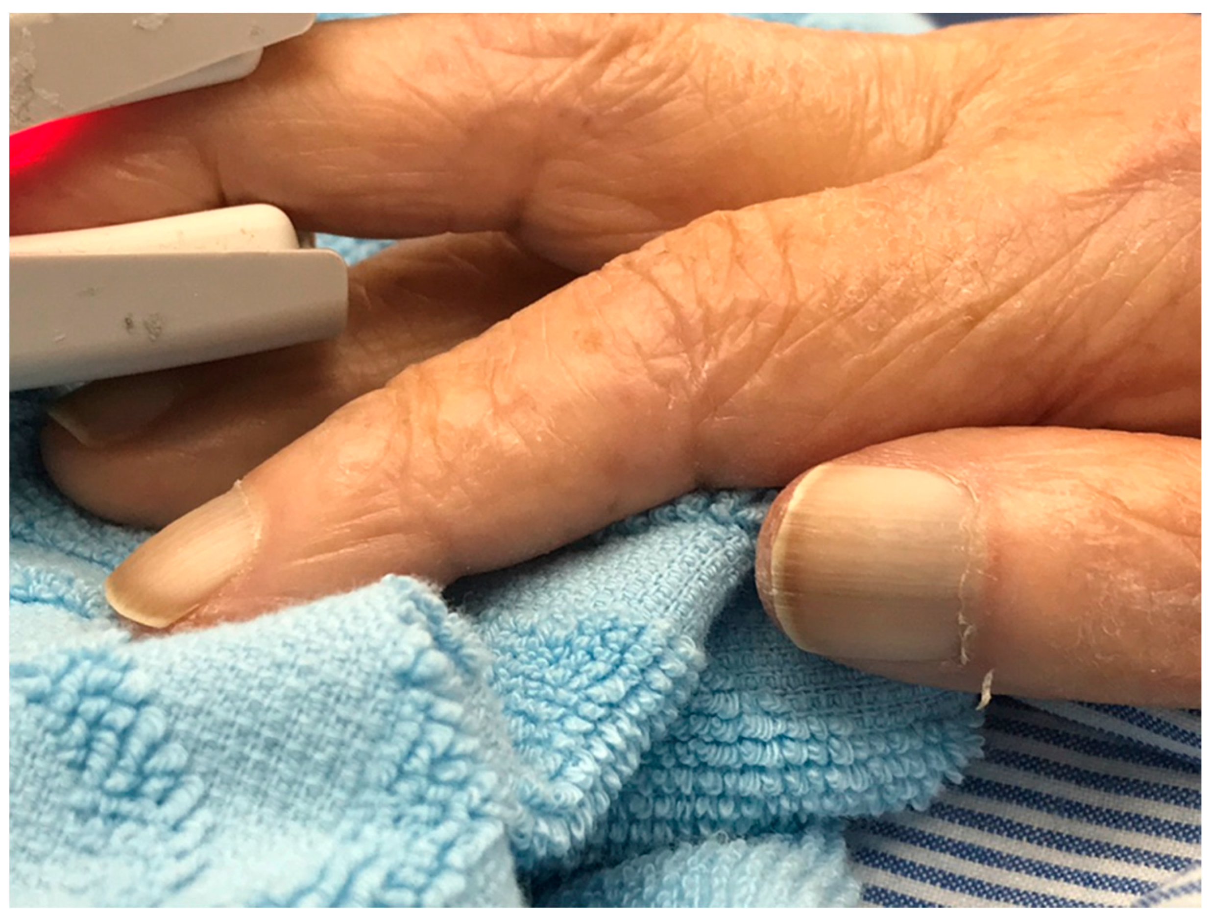 Clinics and Practice | Free Full-Text | White Nail as a Static Physical Finding: Revitalization of Physical Examination Clinics and Practice | Free Full-Text | White Nail as a Static Physical Finding: Revitalization of Physical Examination