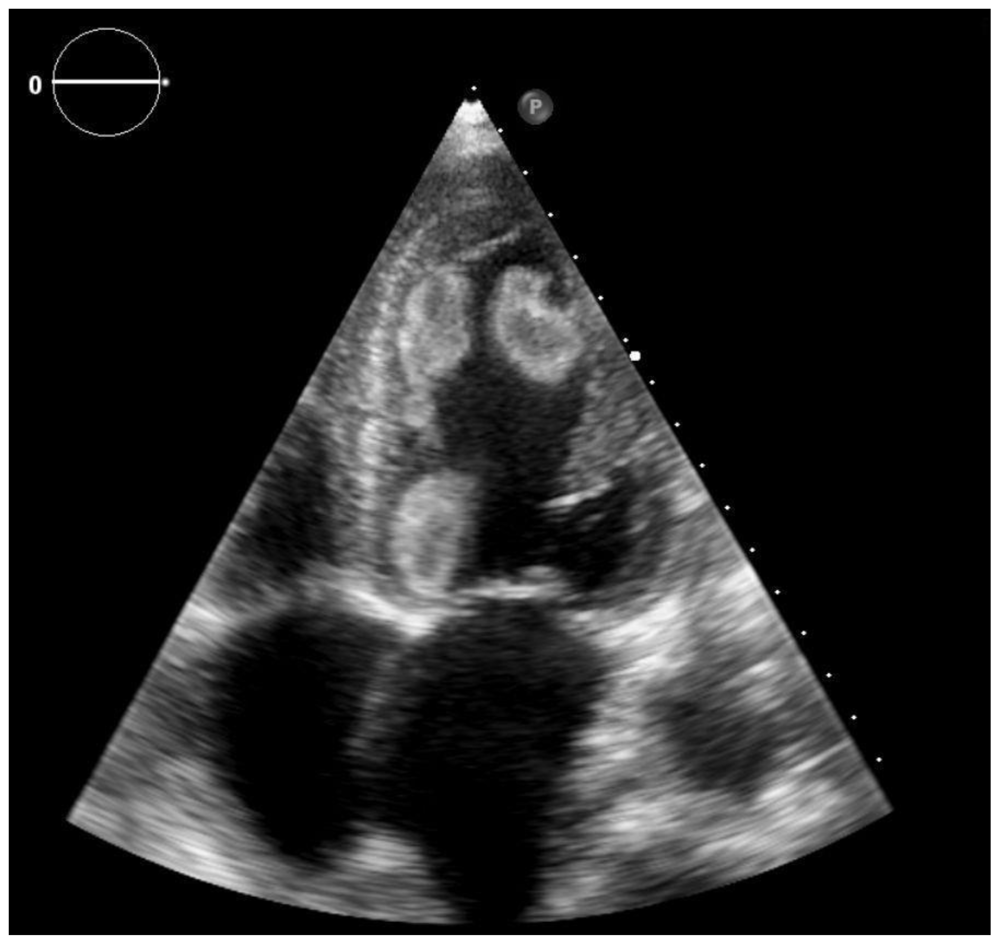 2-D echocardiography showing severe global hypokinesia and left