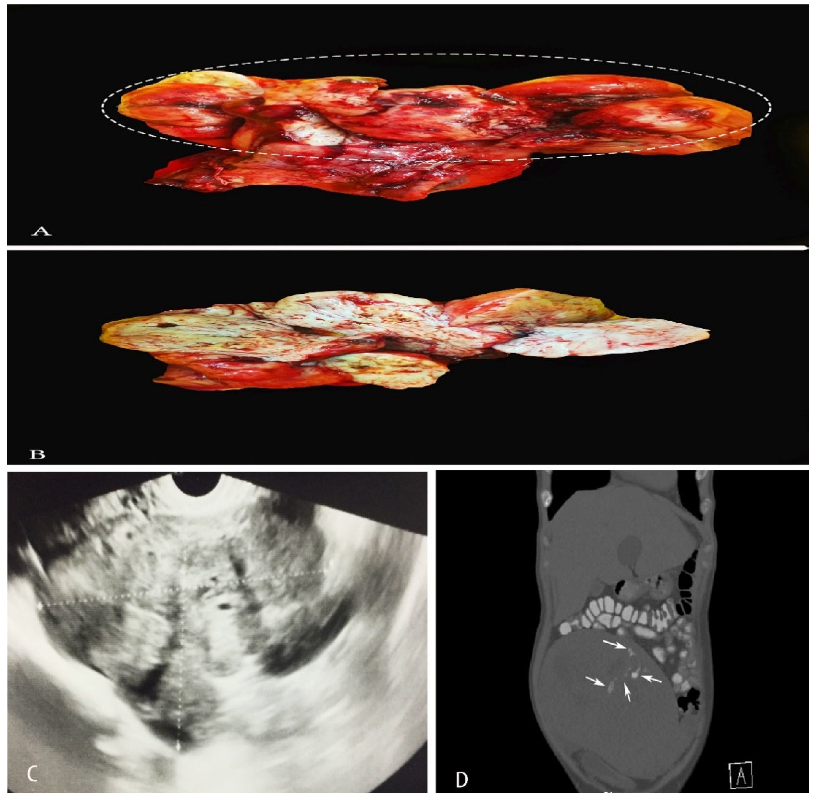 Hemoperitoneum caused by bleeding of adenomyosis: a case report