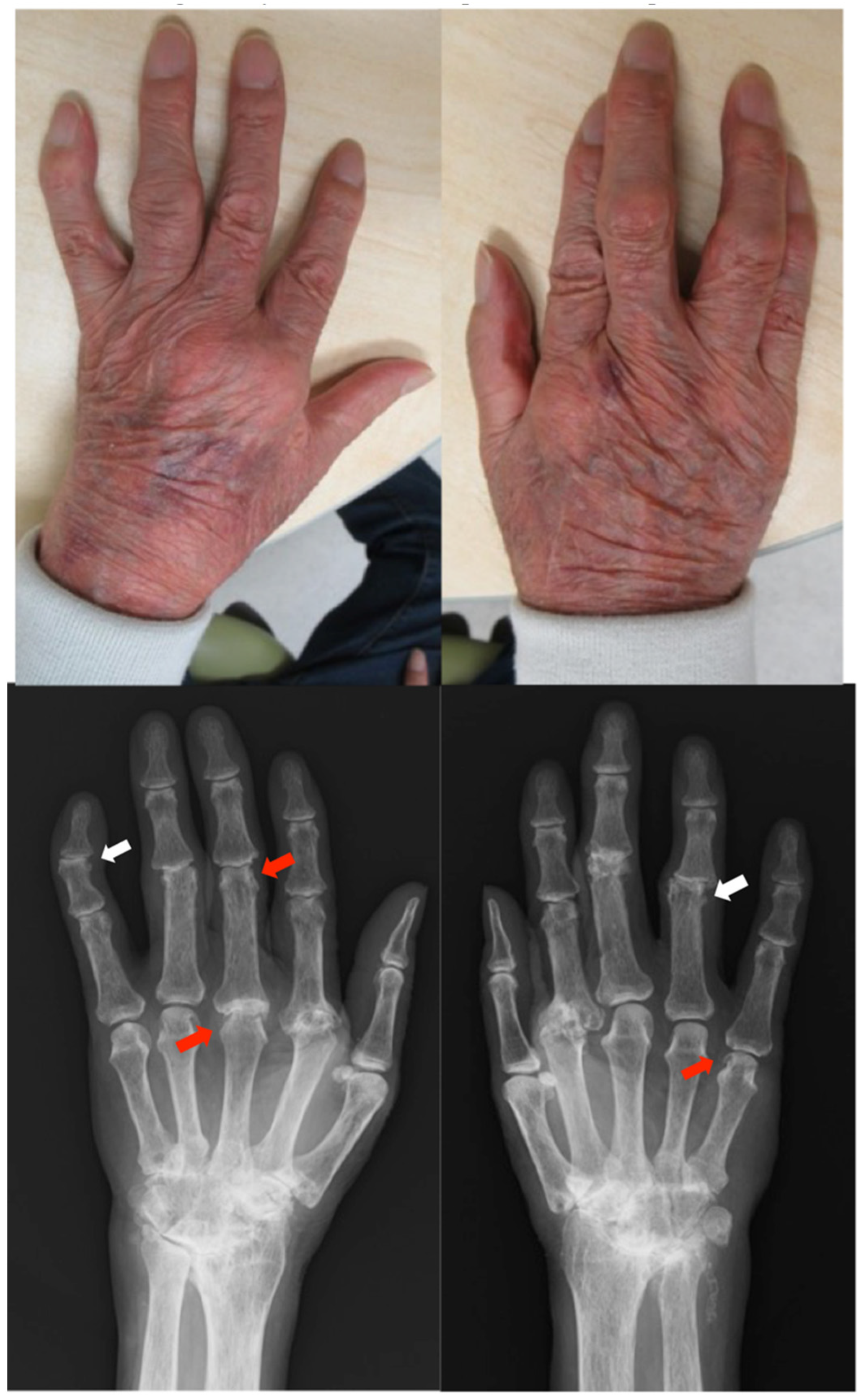 What is an effective and natural way to treat rheumatoid arthritis? - Quora