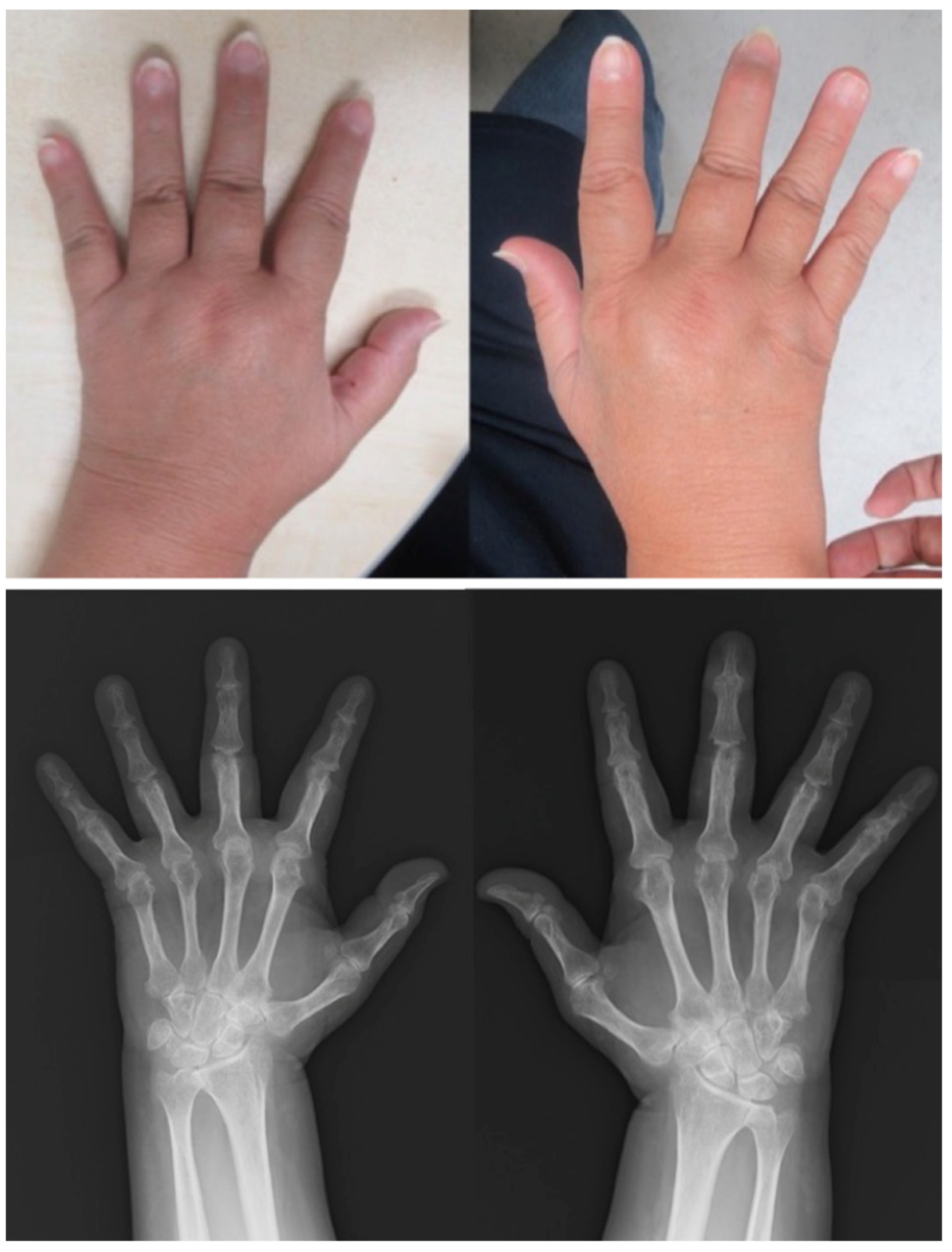 Clinics and Practice | Free Full-Text | Treatment in Patients with Psoriatic Disease and Rheumatoid Arthritis: Seven Case Reports