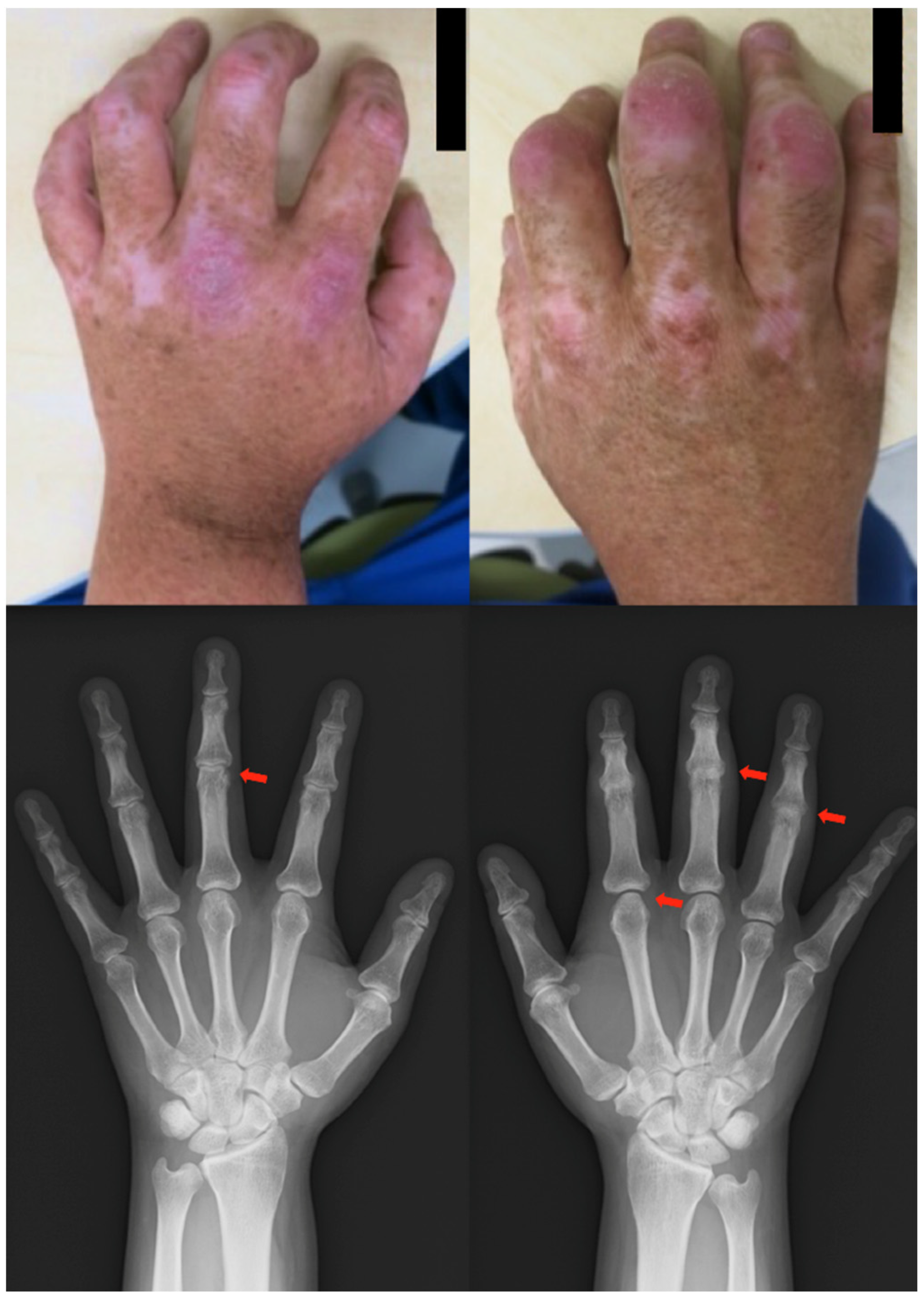 treatment-in-patients-with-psoriatic-disease-and-rheumatoid-arthritis