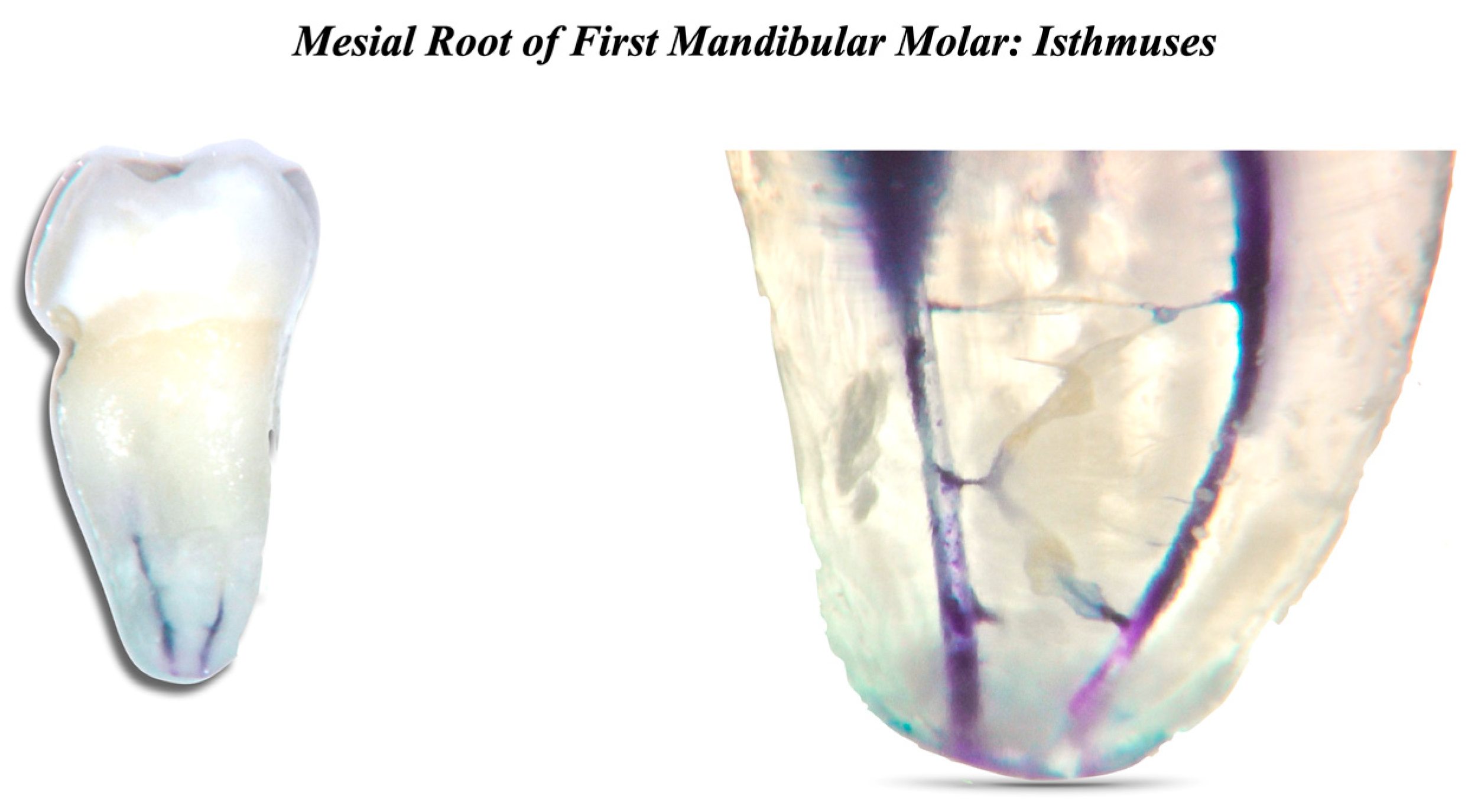 Clinics and Practice Free FullText RETRACTED Traditional and Recent Root Canal Irrigation