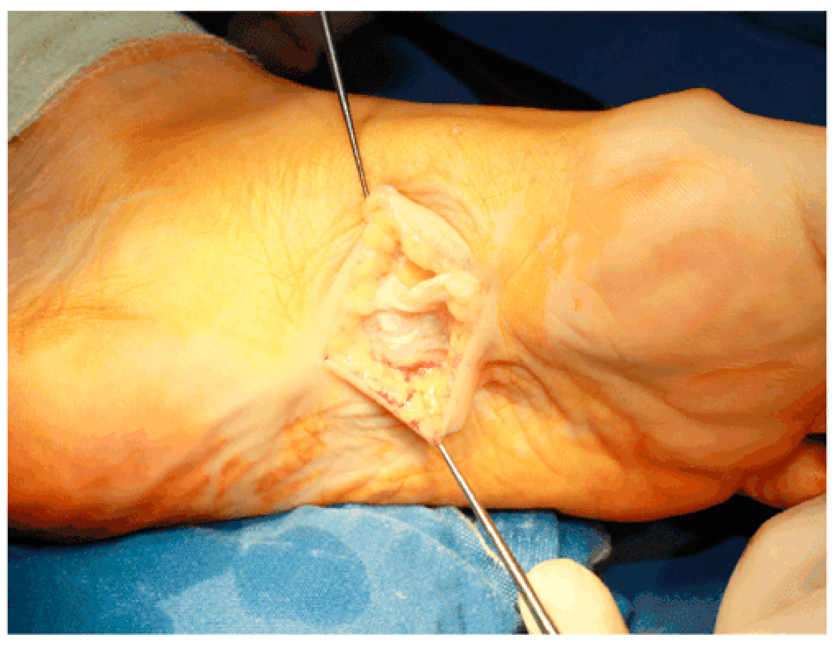 Plantar fibroma on sale treatment 218