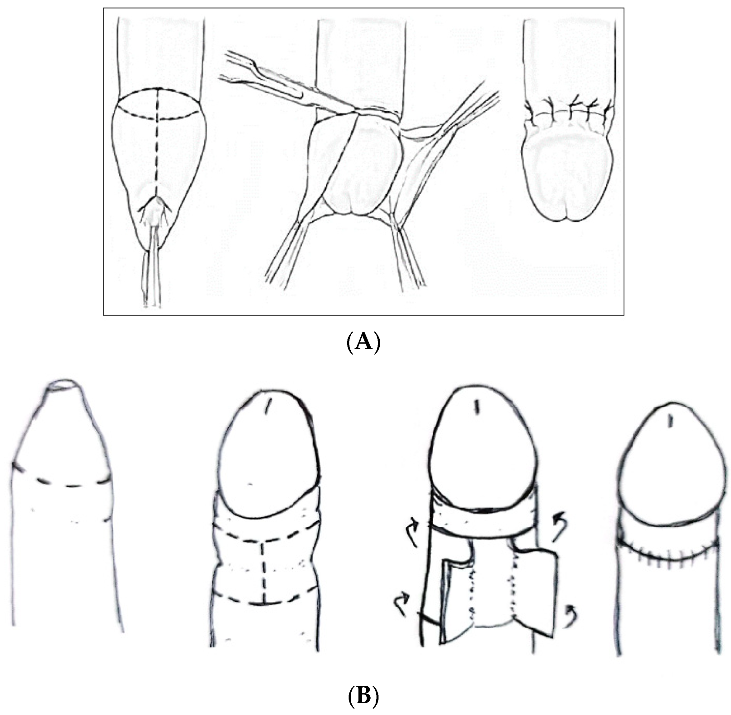 PDF) Management of Plastibell circumcision ring migration and glans penis  incarceration