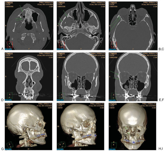 The Comprehensive AOCMF Classification System: Radiological Issues and ...