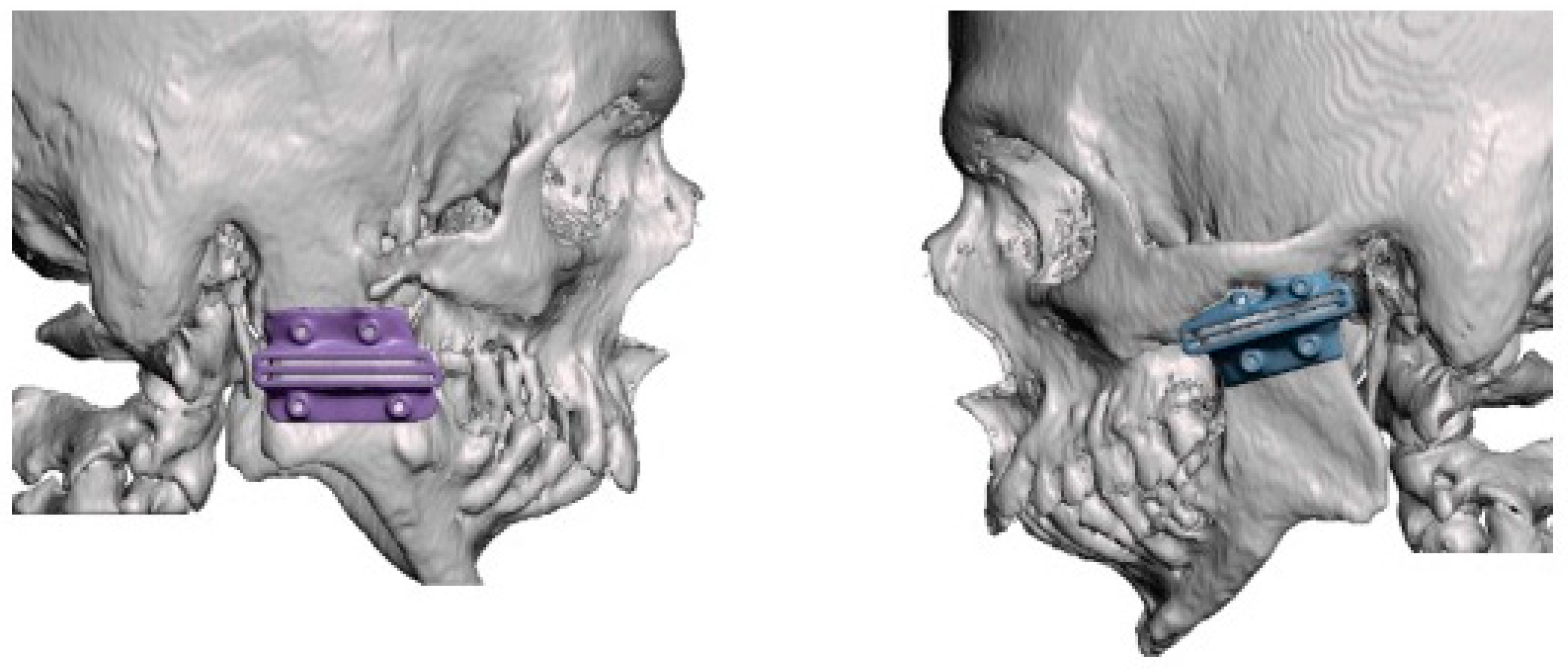 その他 244 TMJ 1st Orthodontics Concepts,Mechan Amazon.com: TMJ 1st Orthodontics Concepts, Mechanics, and