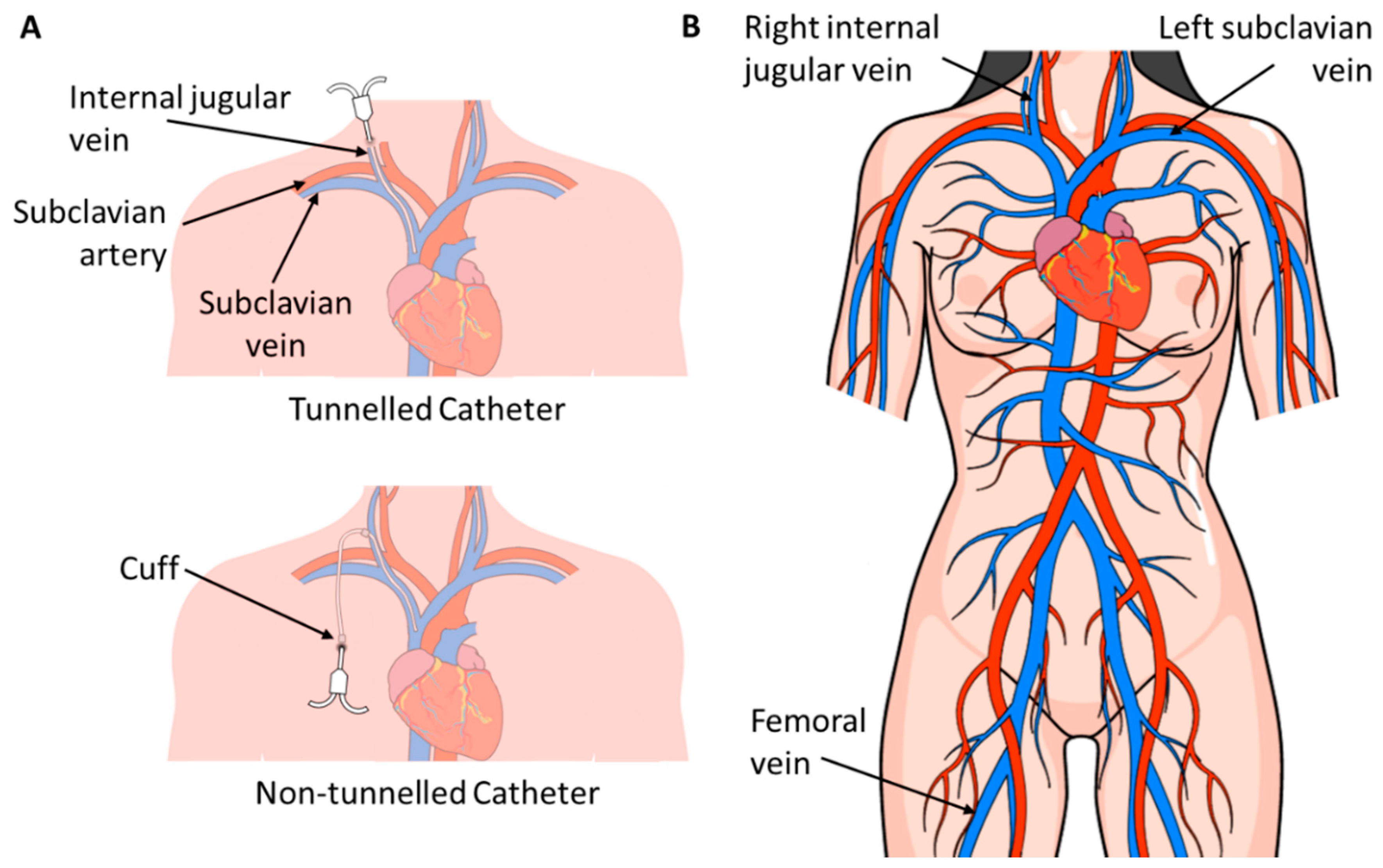 dialysis-catheters-101-renal-fellow-network